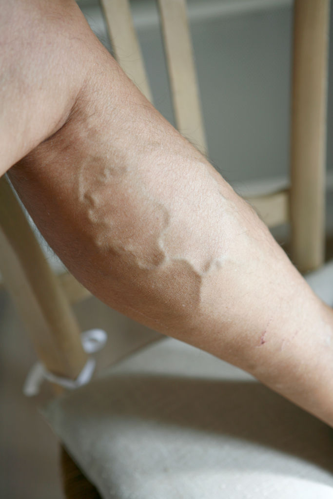 Les causes de l'insuffisance veineuse chronique
