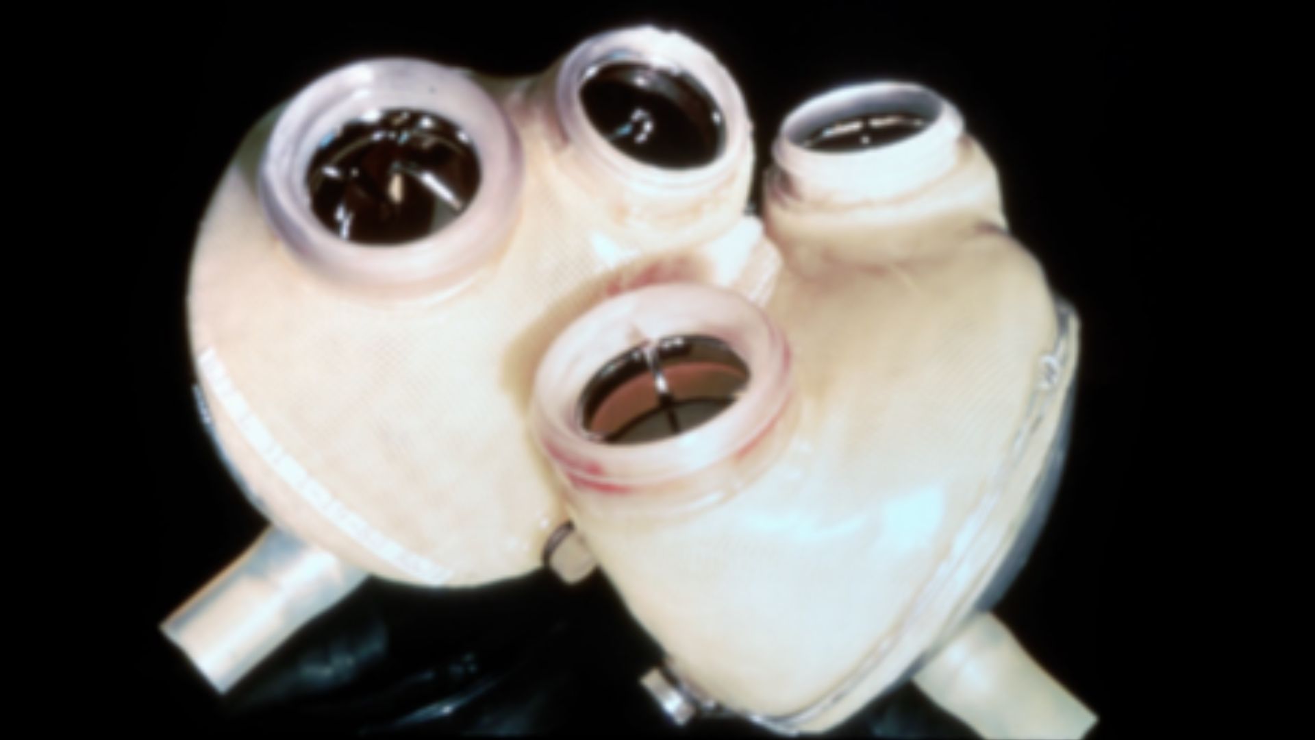 4. Première transplantation de cœur artificiel