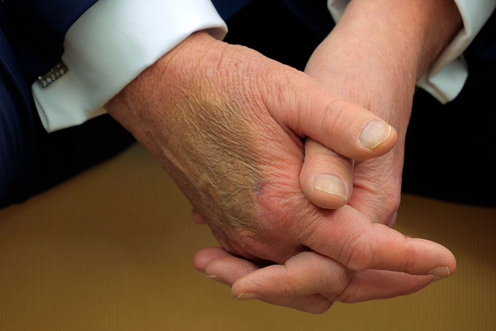 Trump's bruises create speculation
