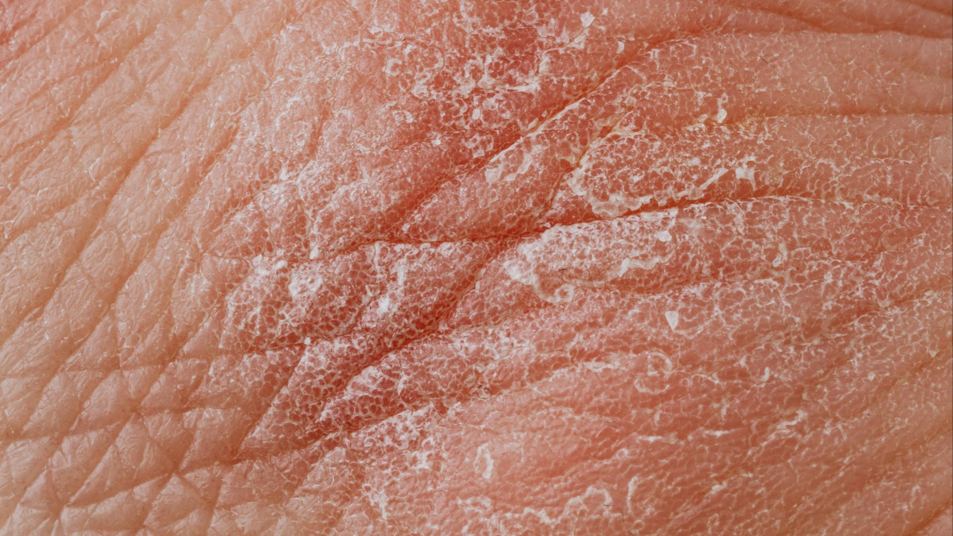 9. Aggraver les affections cutanées
