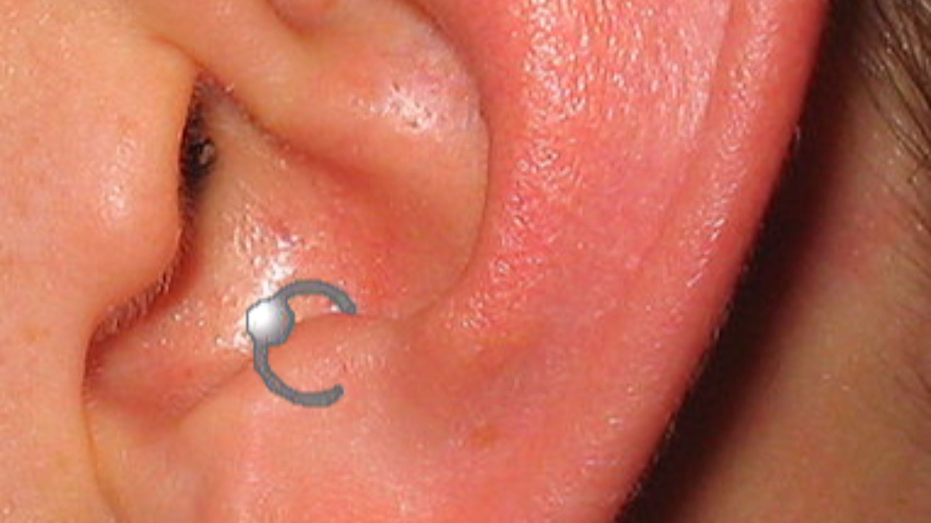 3. Anti-Tragus