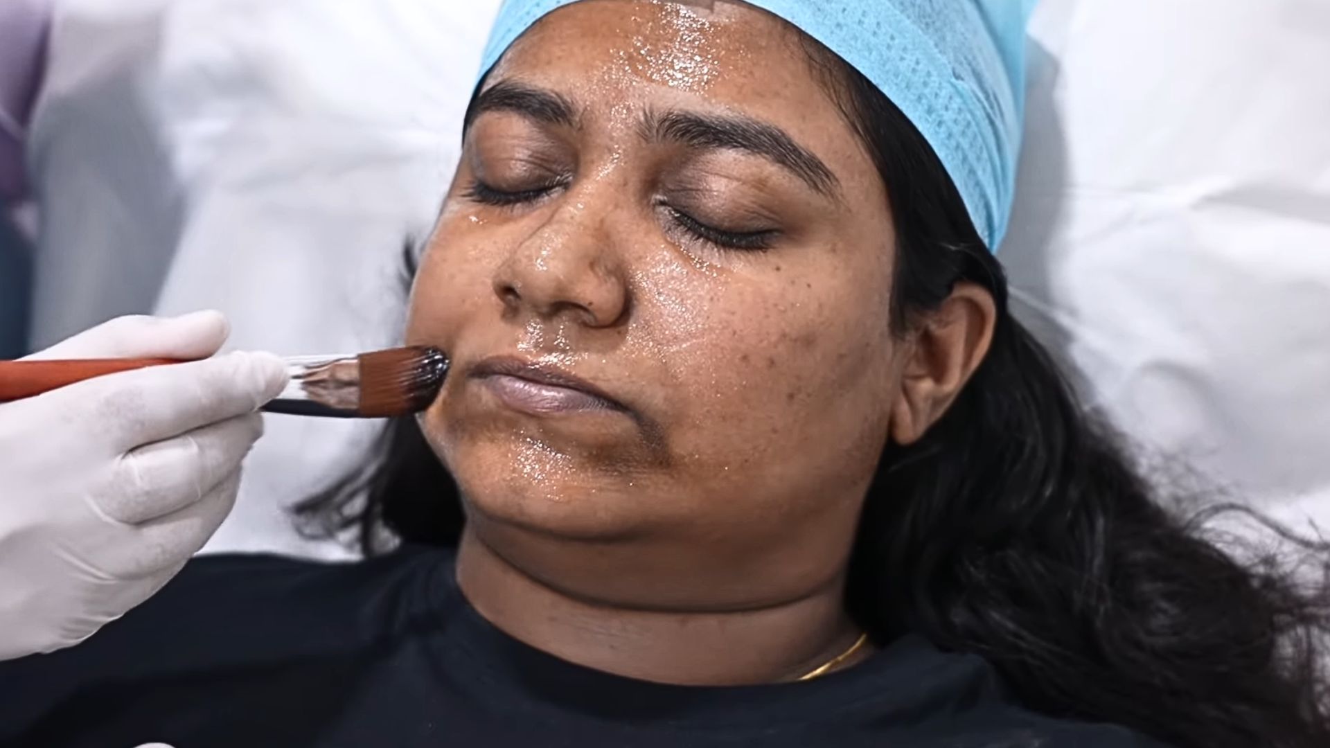 16. Programme de peeling chimique professionnel