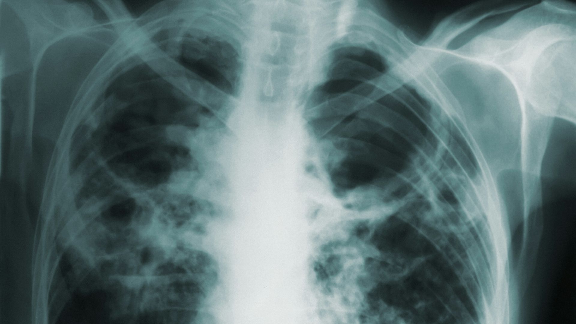 2. Tuberculose