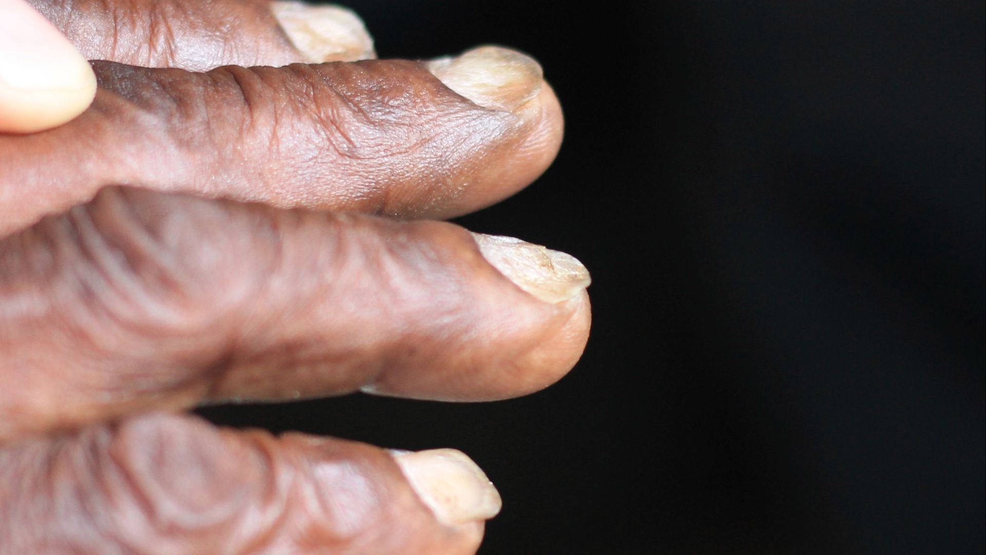 4. Les ongles de la cuillère