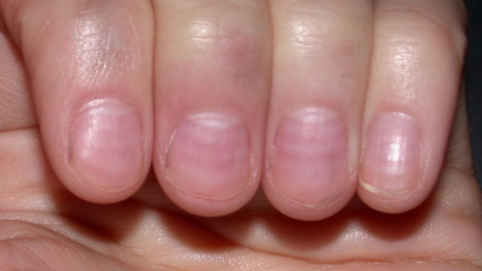 12. Bandes blanches sur l'ongle (lignes de Muehrcke)