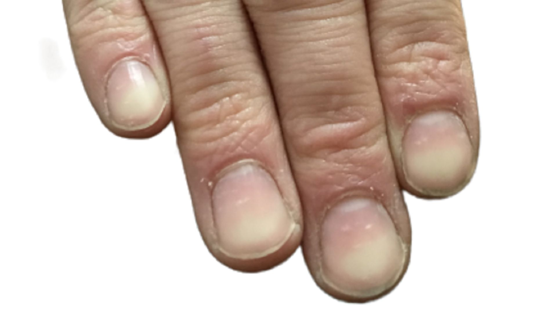 14. Ongles épaissis