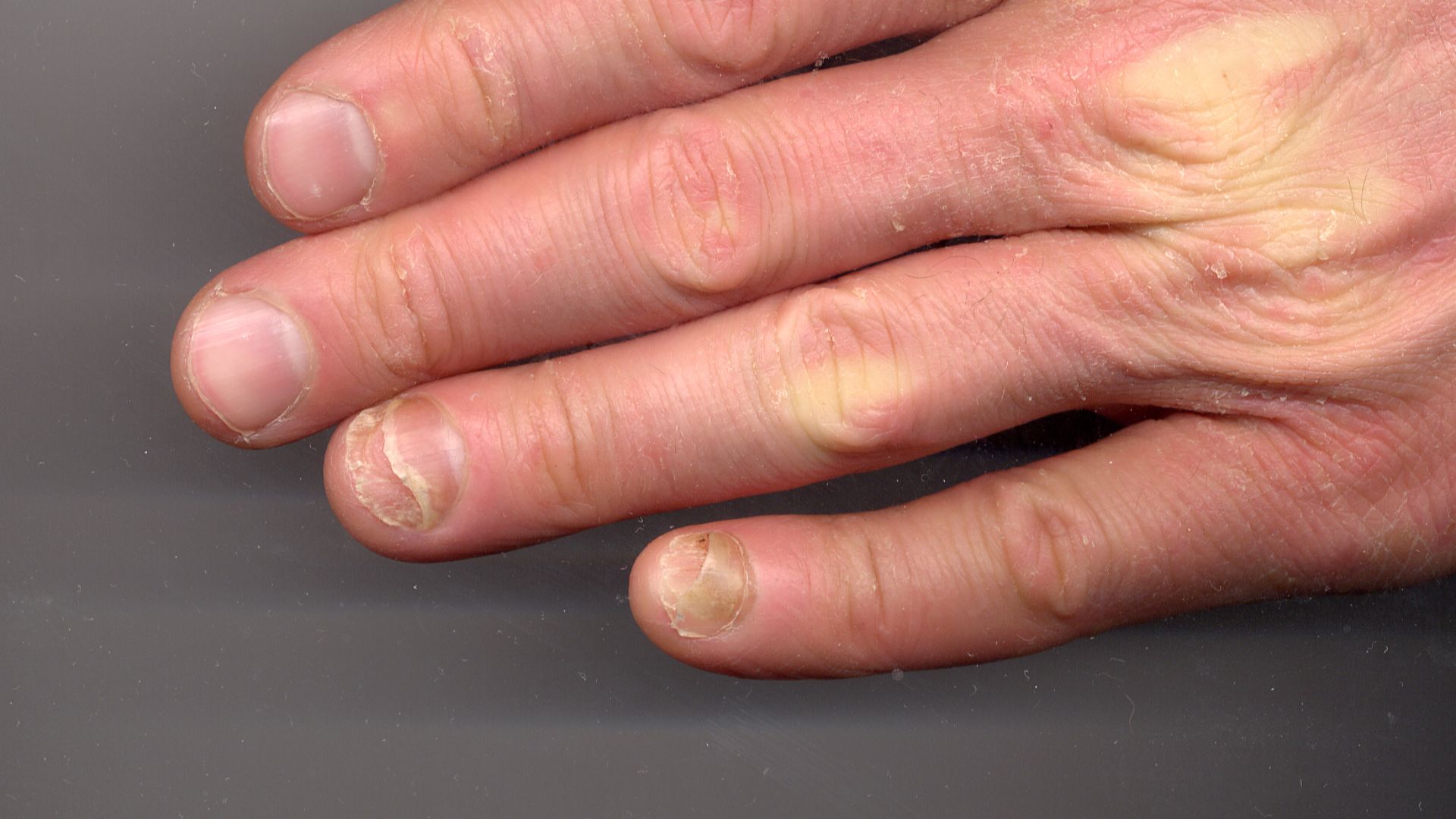 15. Ongles décollés ou soulevés (Onycholyse)