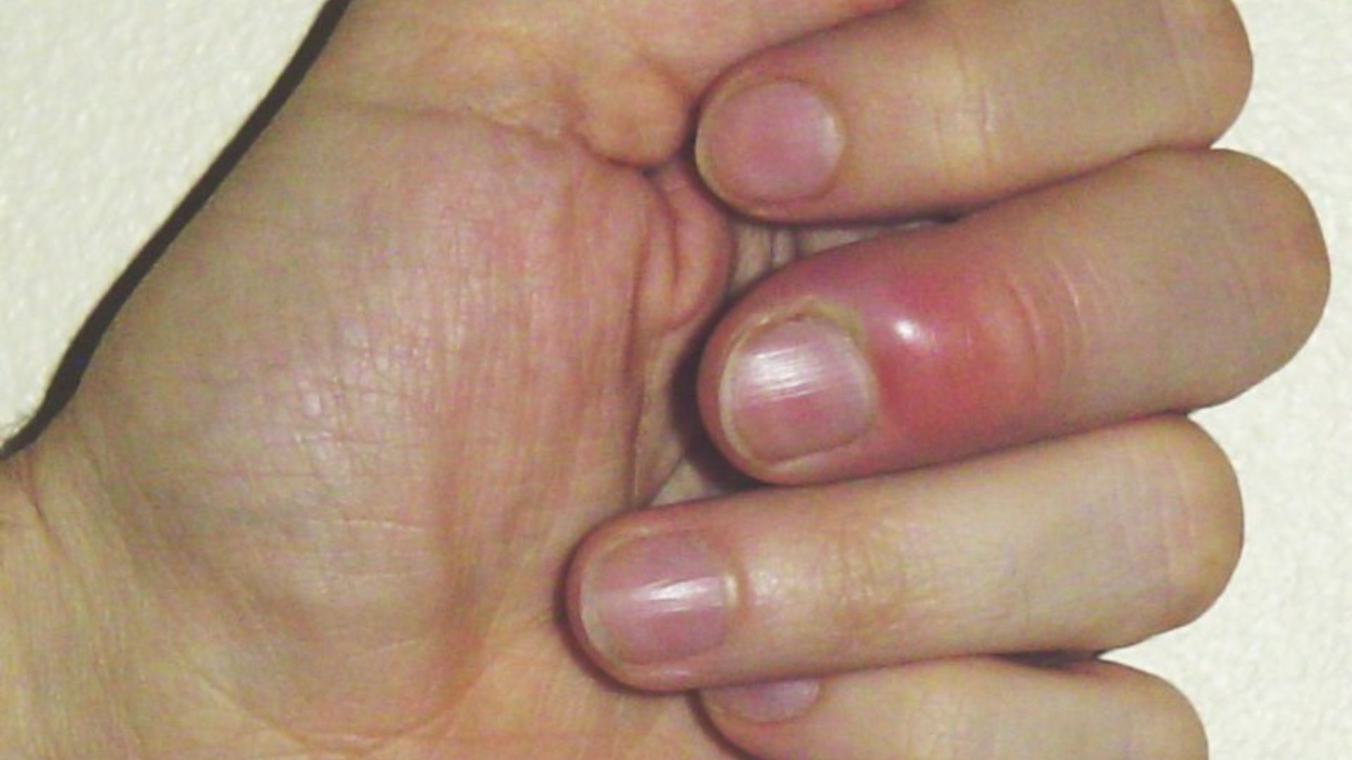 16. Cuticules ou replis de l'ongle rouges