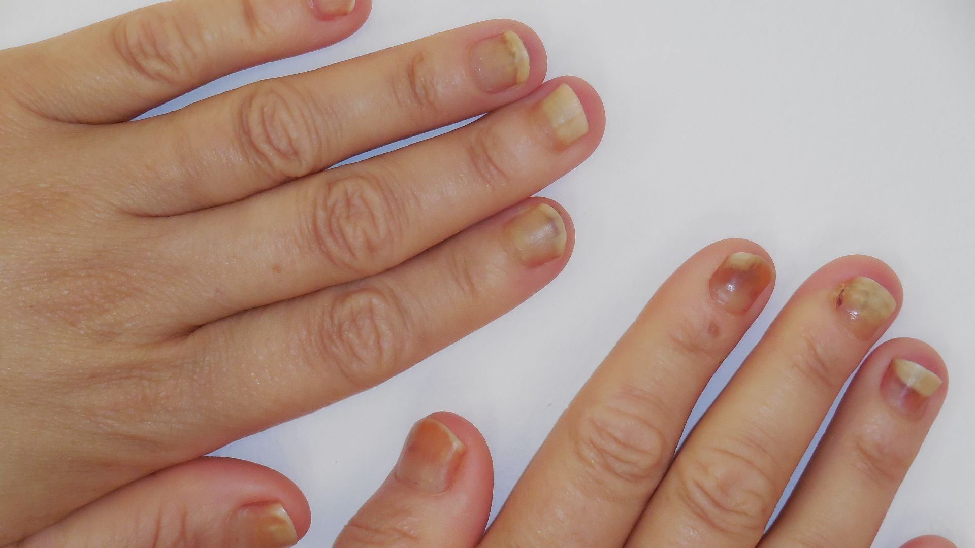 19. Ongles minces et décollés