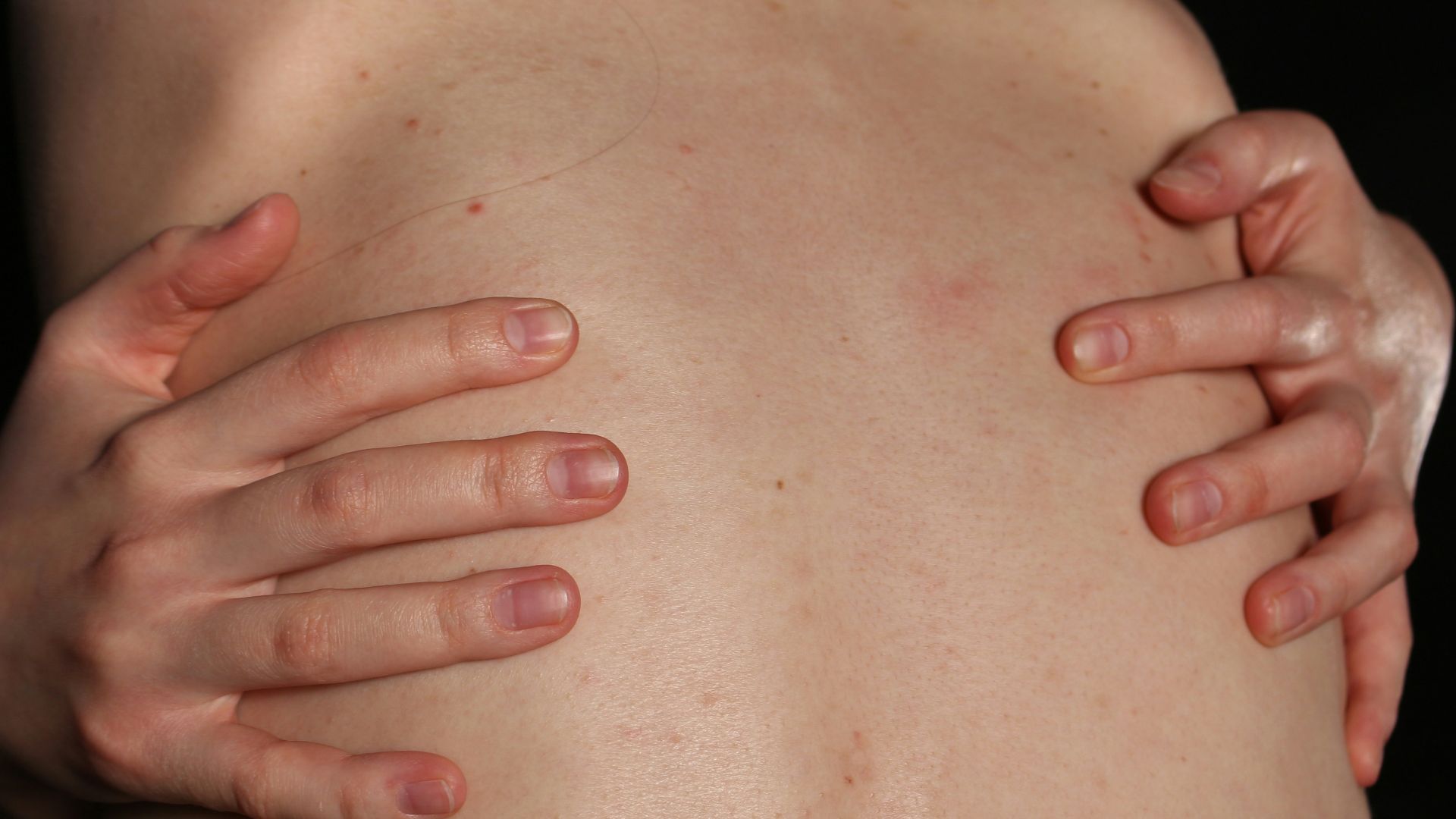 3. Fibromyalgie