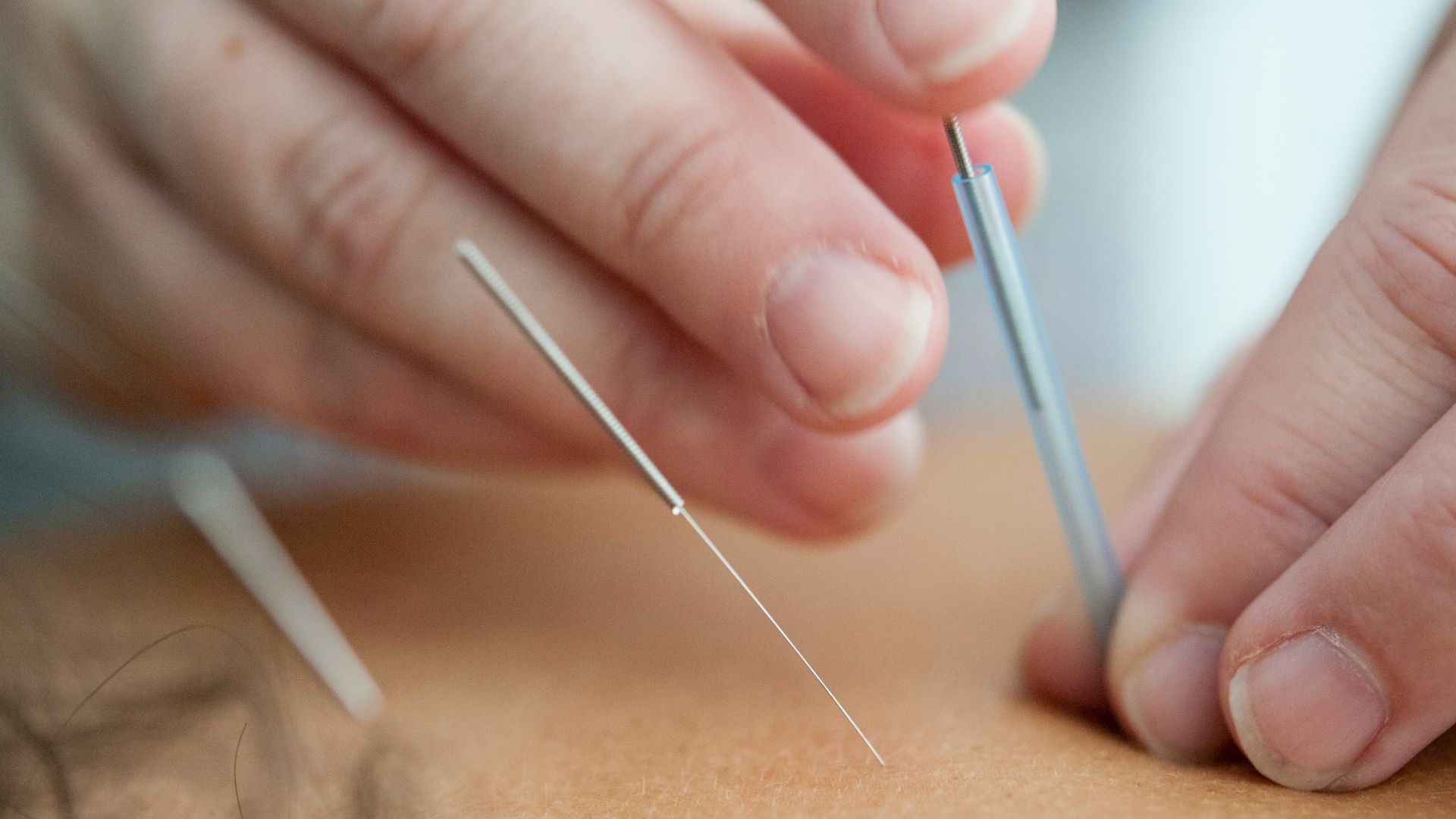 3. Essayez l'acupuncture