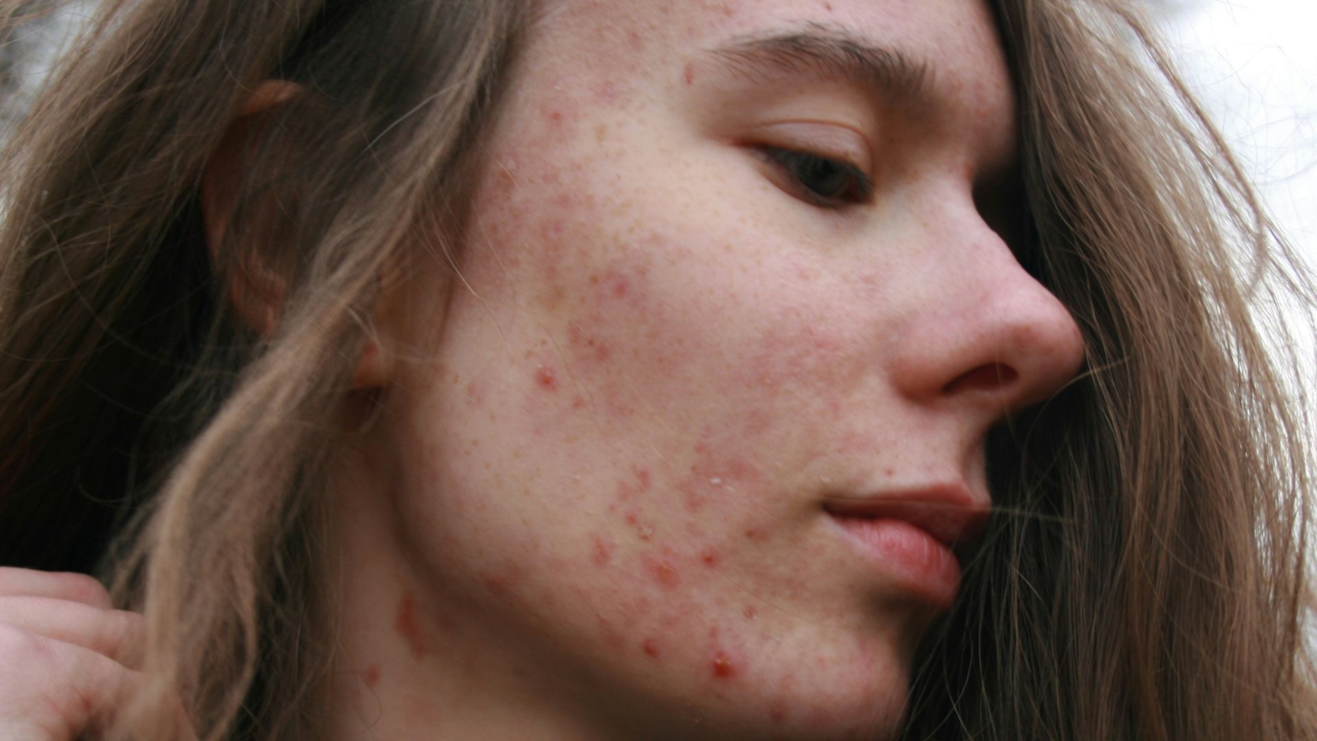 9. Peau terne