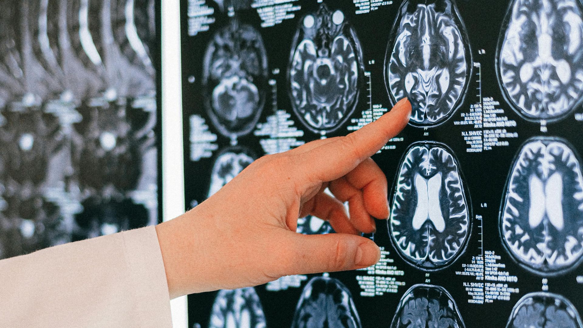 9. La maladie d'Alzheimer