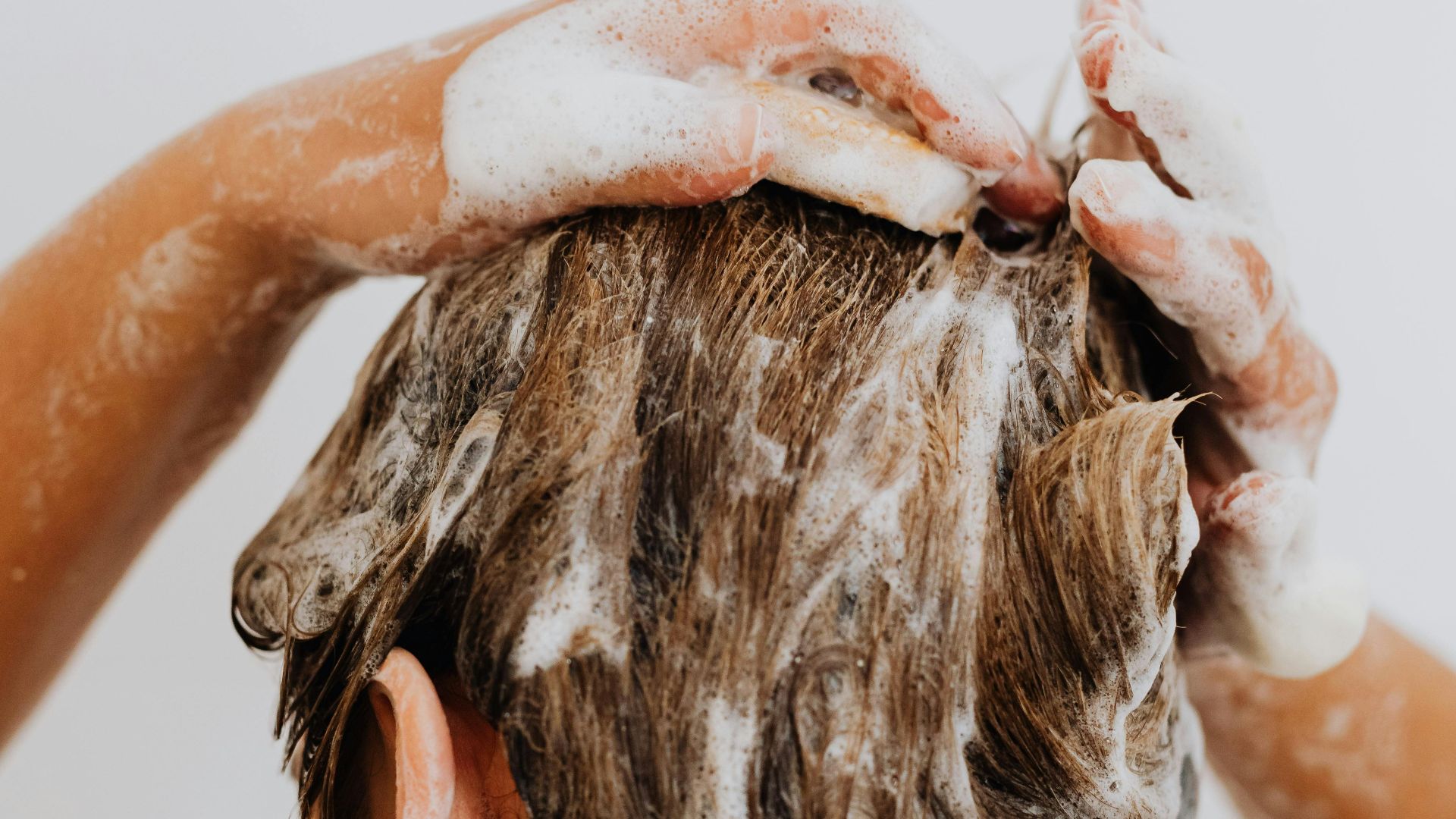 6. Psoriasis du cuir chevelu