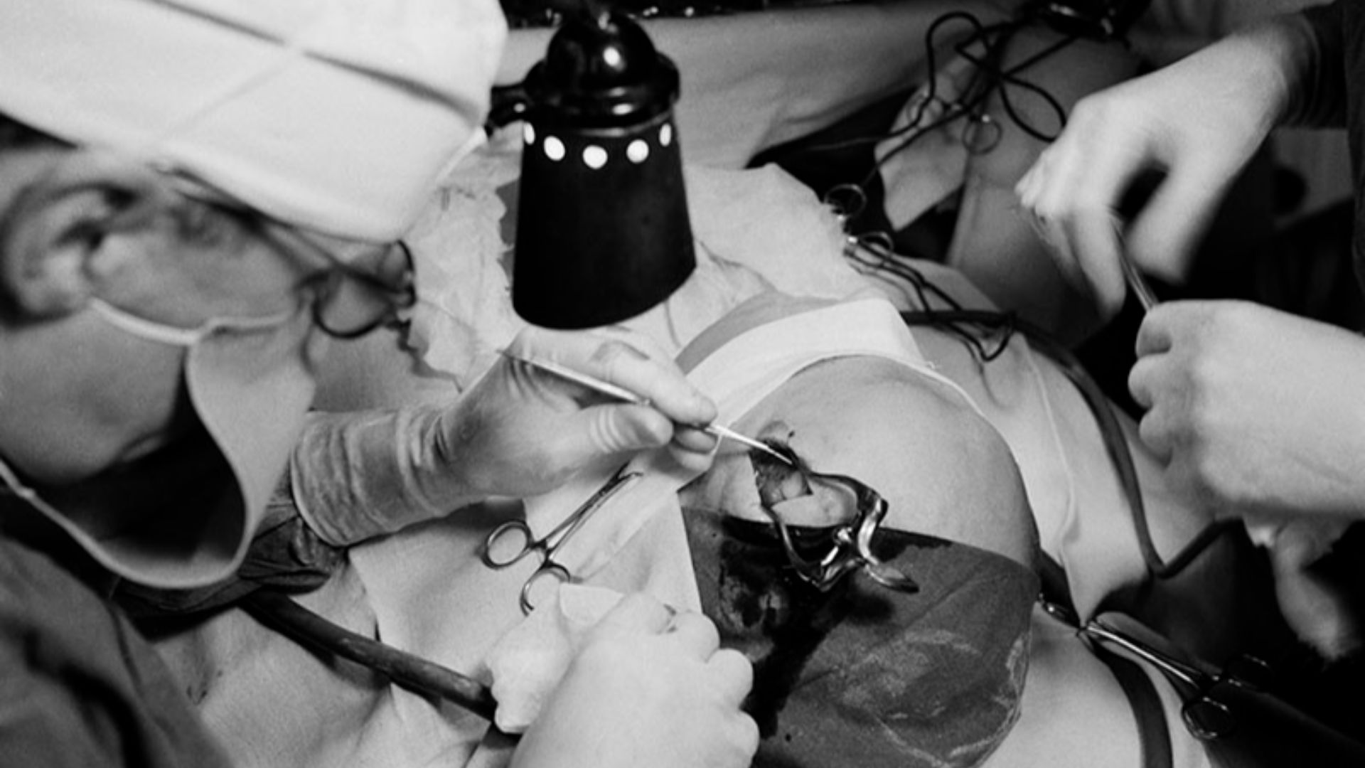 12. Lobotomie Technique du pic à glace