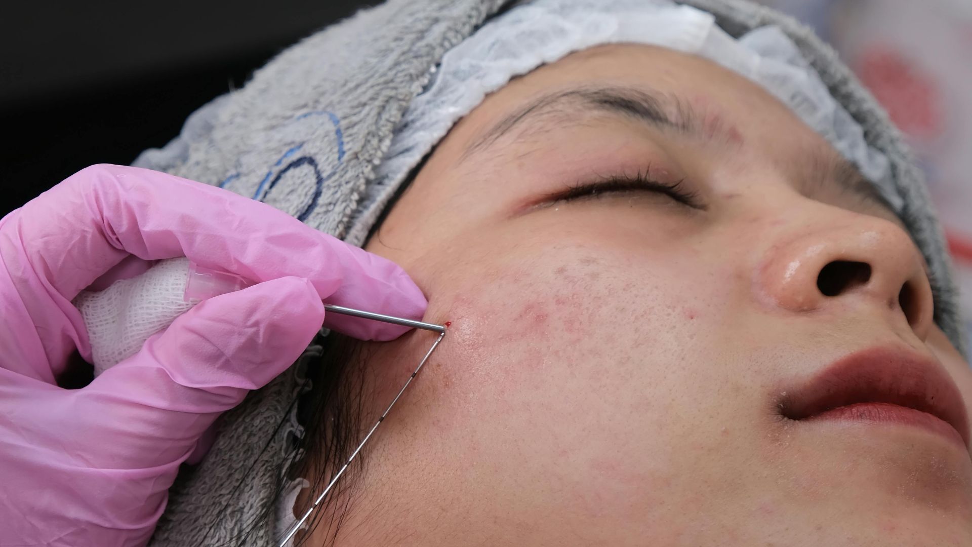 2. Microneedling