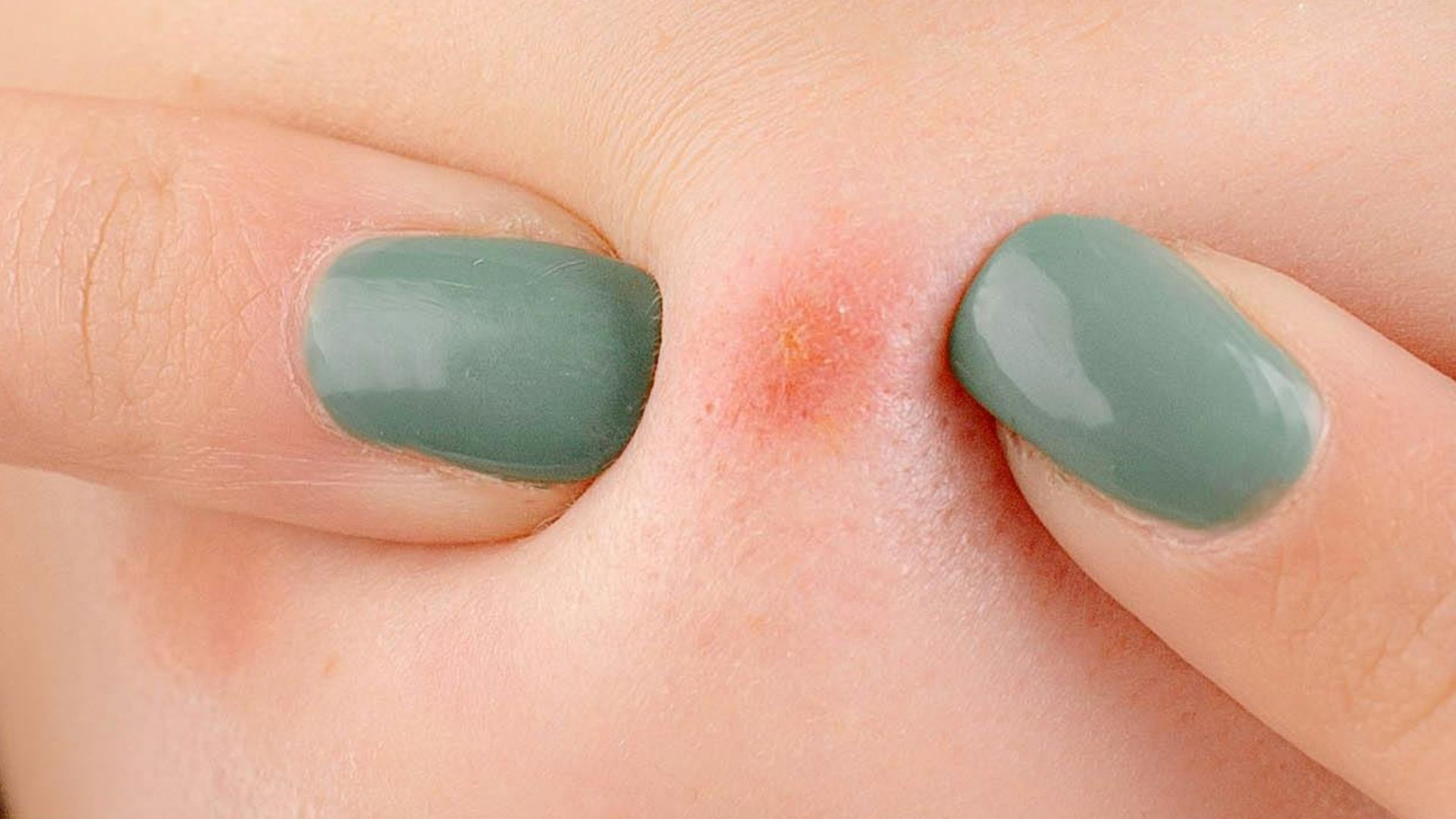 5. Extraction des pores