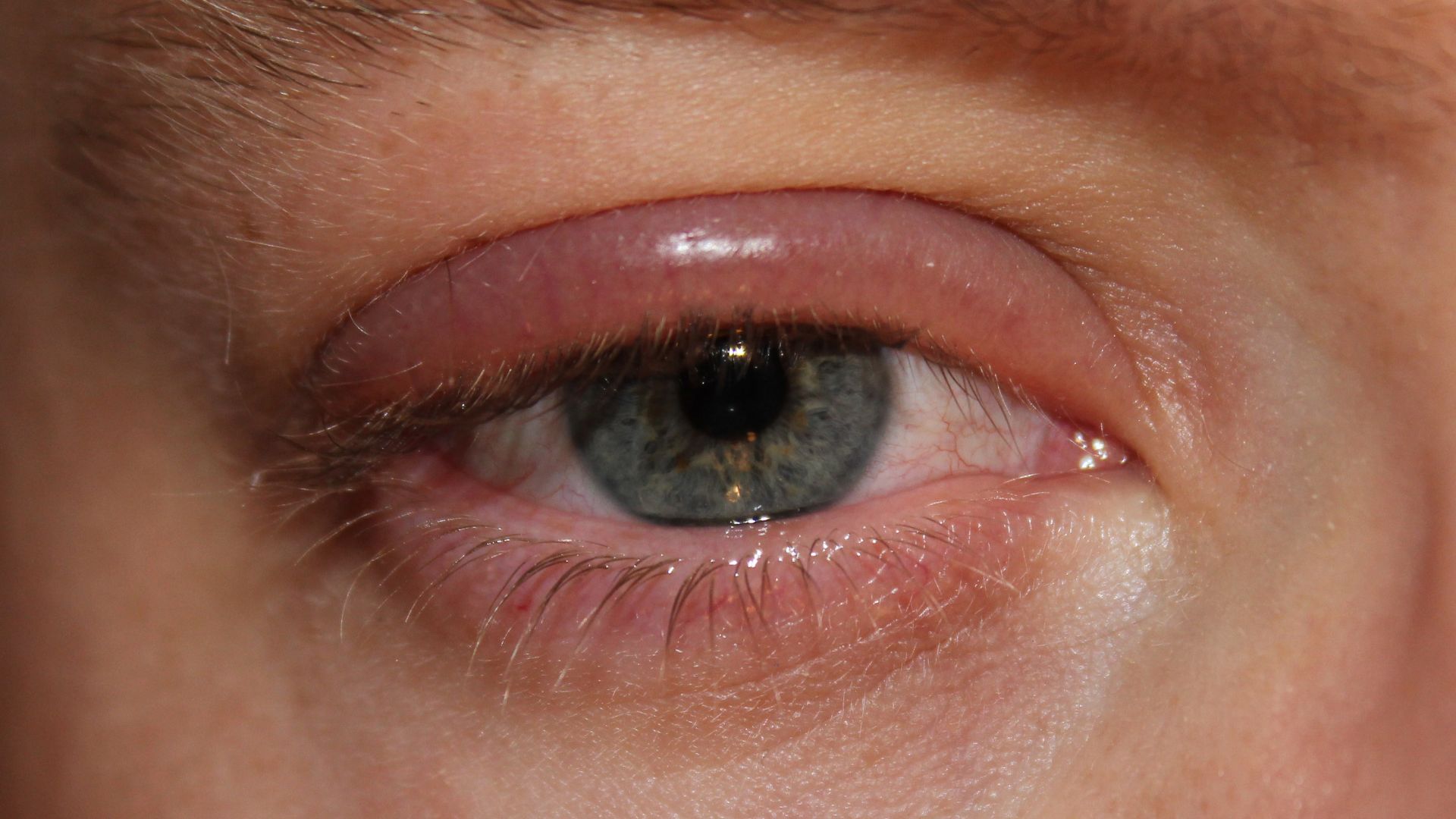 6. Inflammation des paupières dont vous ignorez l'existence