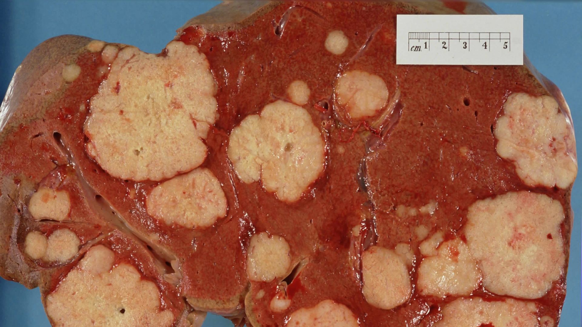 4. Cancer du pancréas avancé