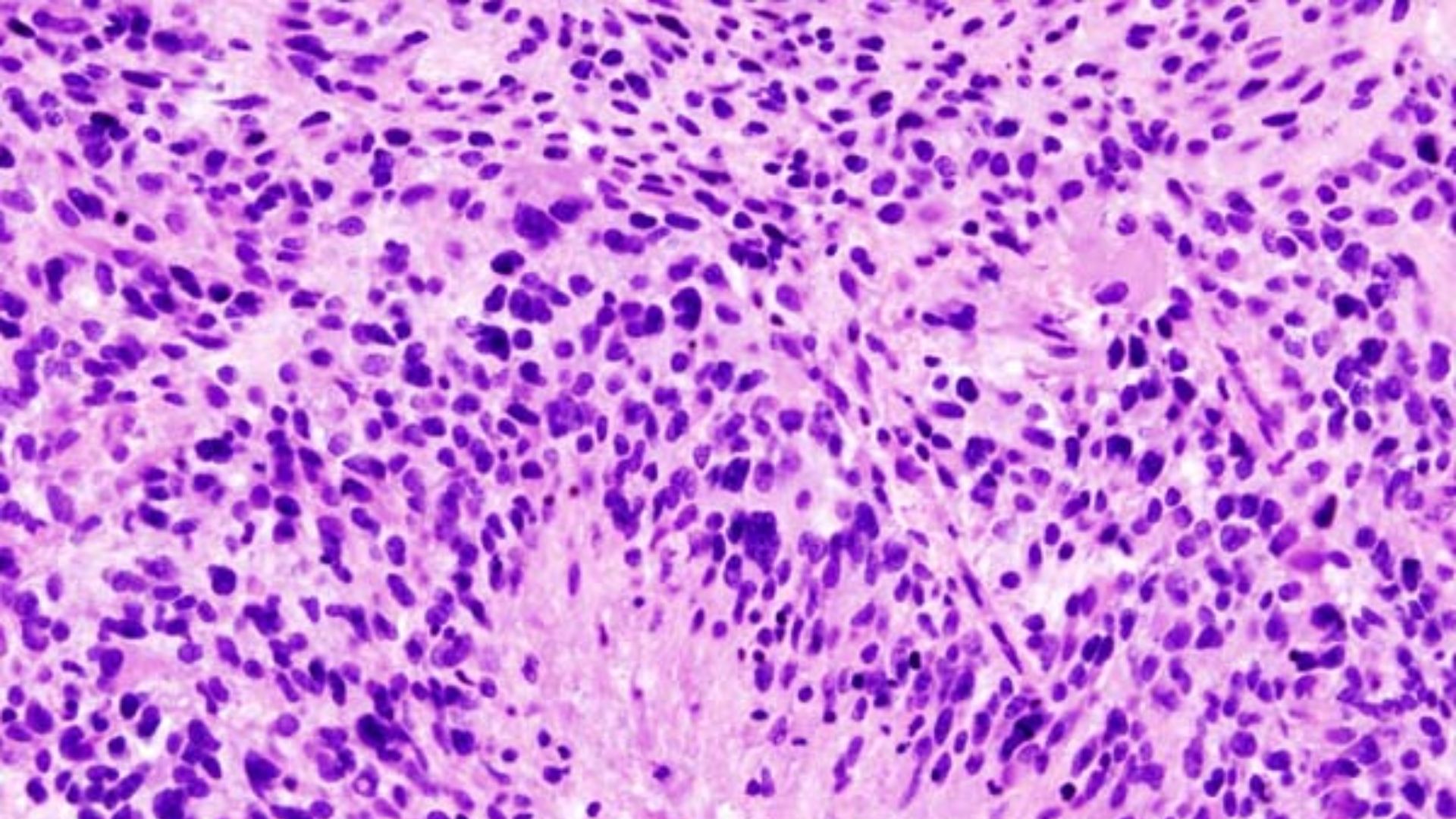 5. Glioblastome