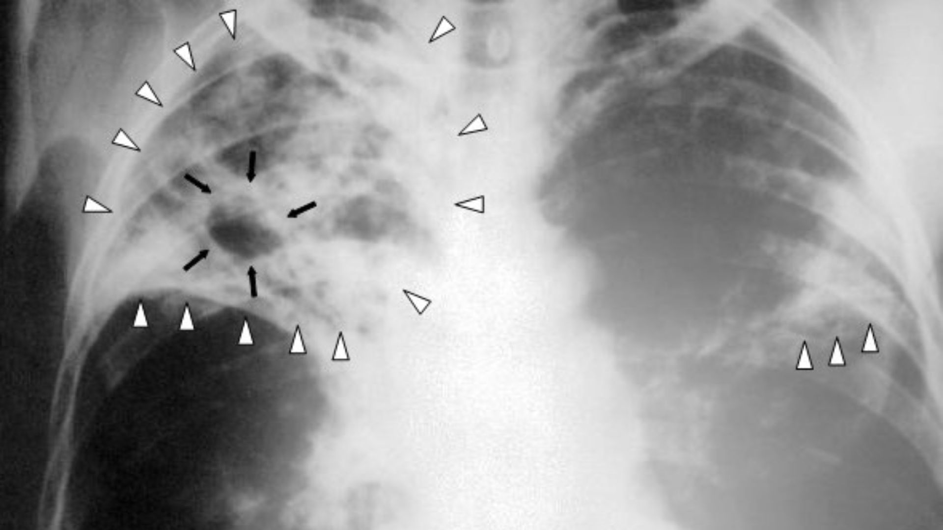7. La tuberculose multirésistante