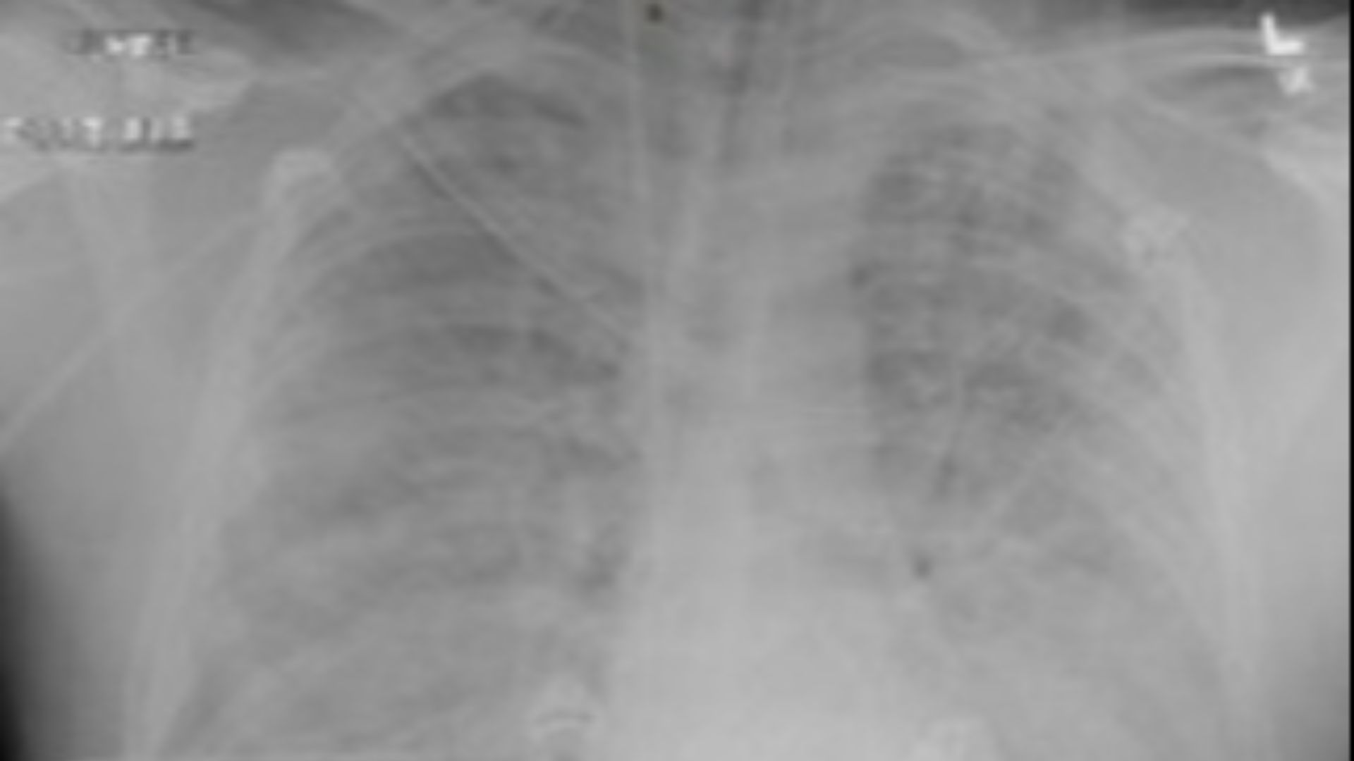9. Syndrome pulmonaire à hantavirus