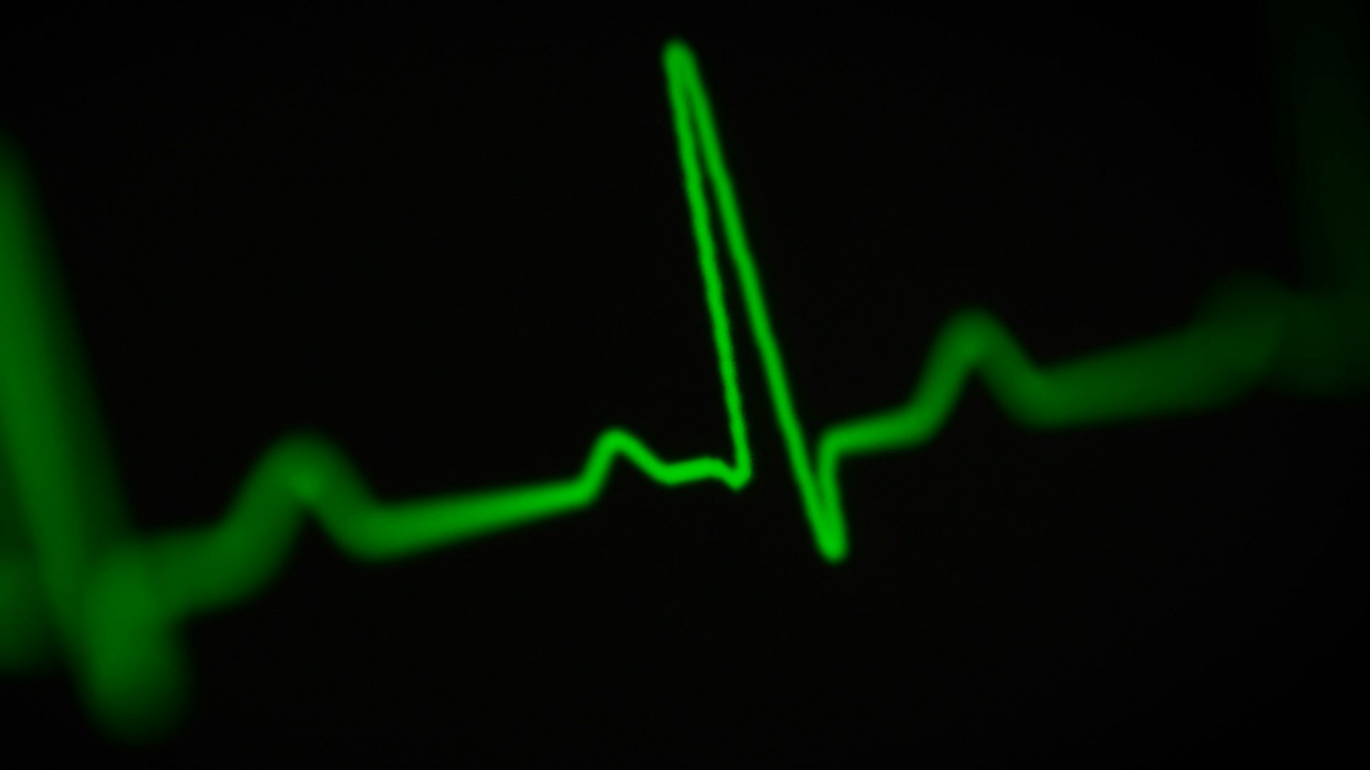 4. Arythmie cardiaque