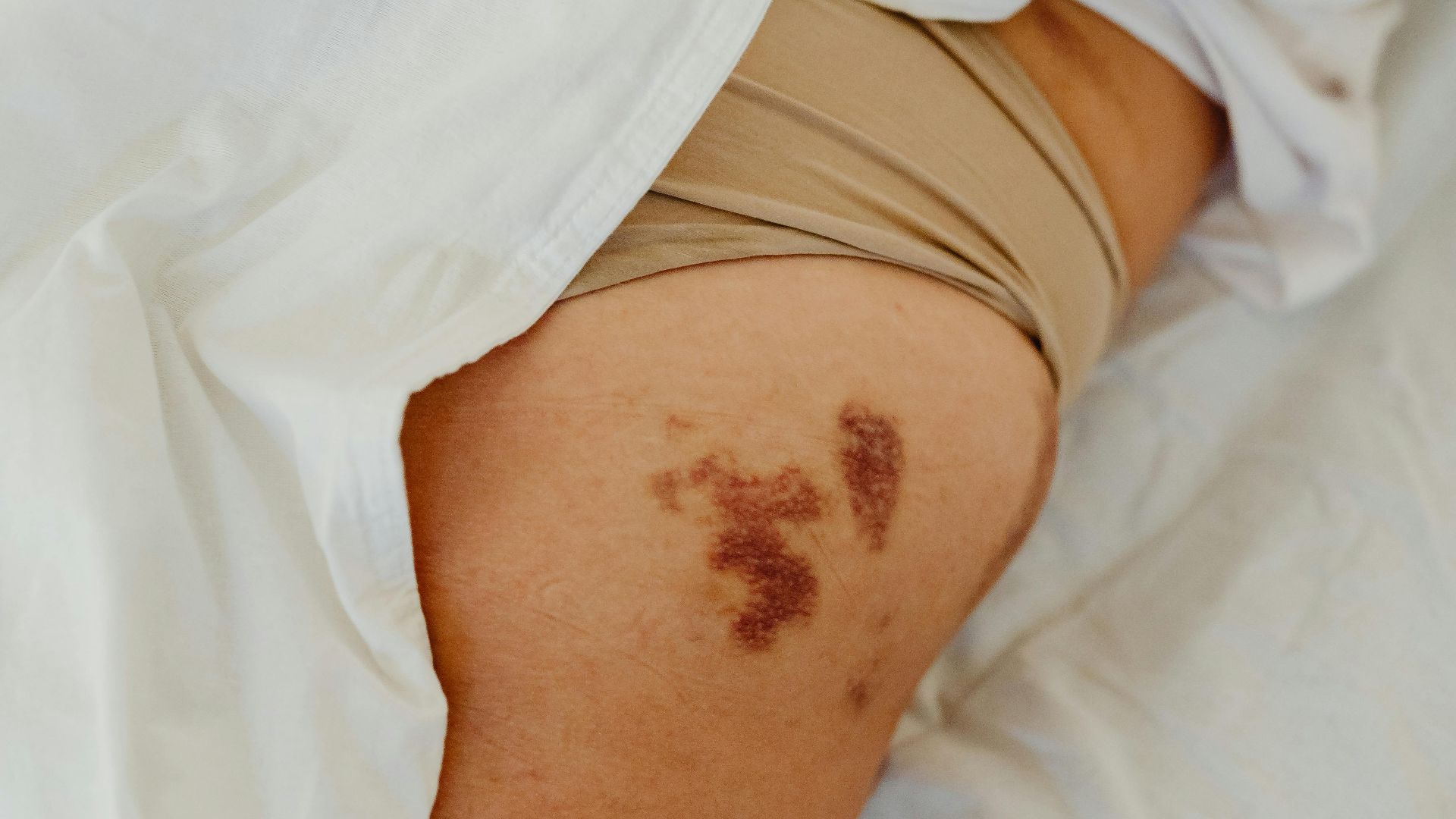 11. Se promener avec des blessures « mineures » 