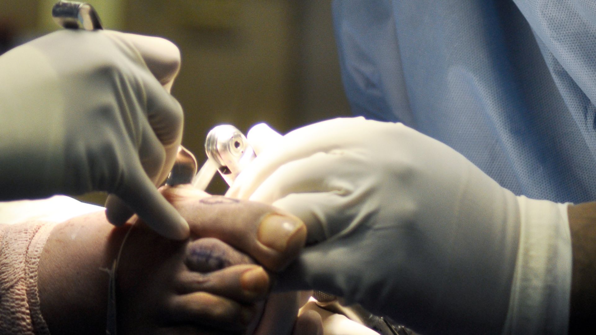 10. Subir une chirurgie mini-invasive du hallux valgus