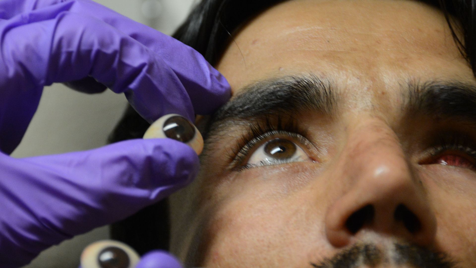 9. Rejet de la prothèse oculaire