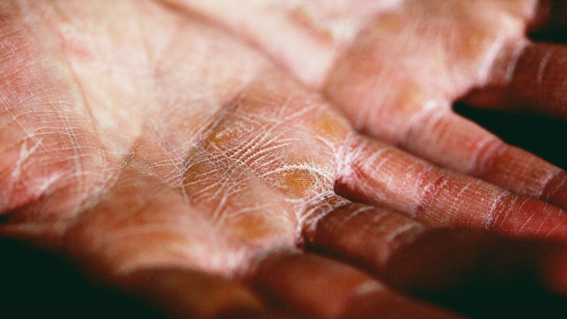 12. La peau devient plus sèche, plus fine et plus susceptible aux ecchymoses
