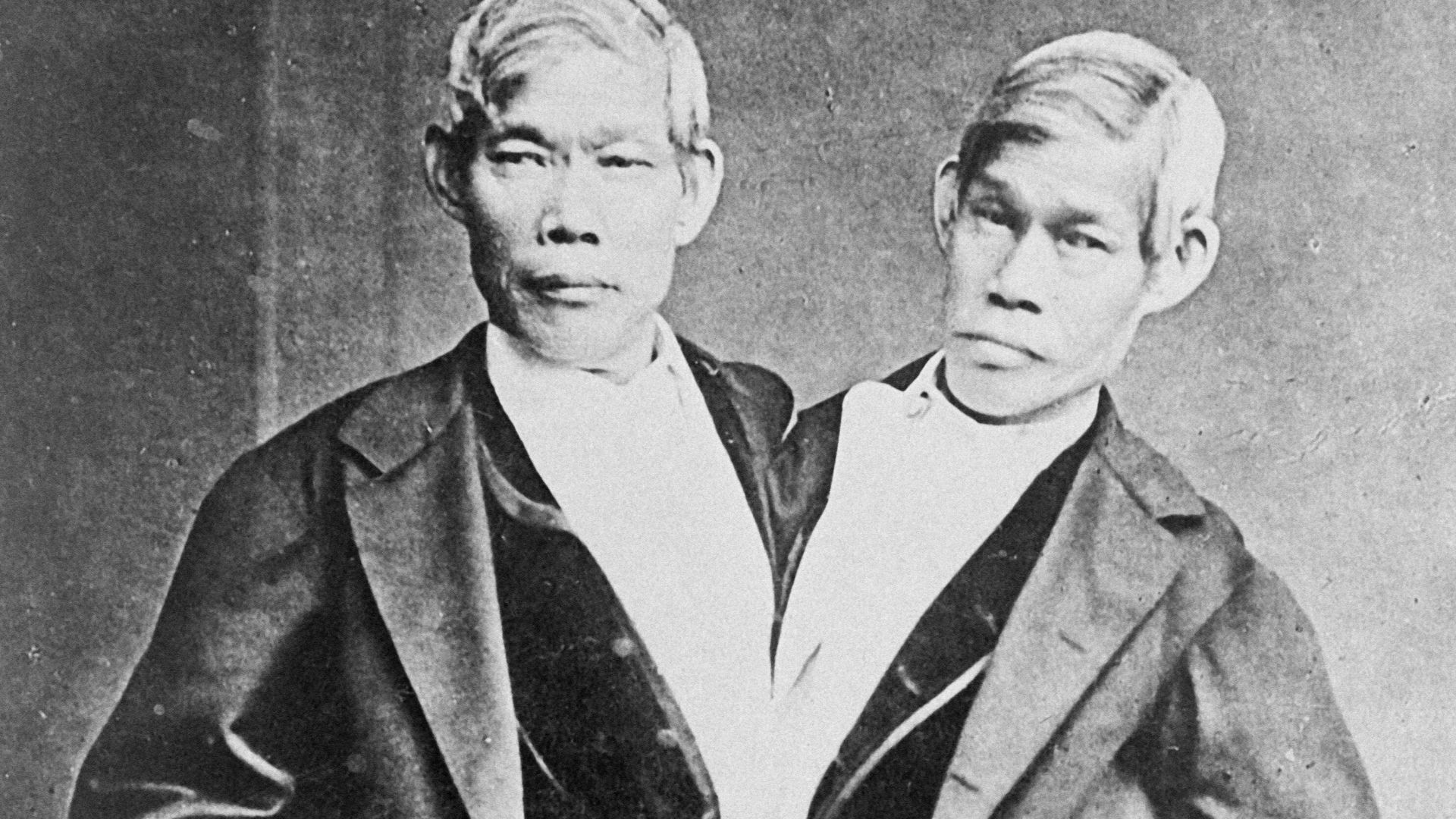 4. Les jumeaux siamois