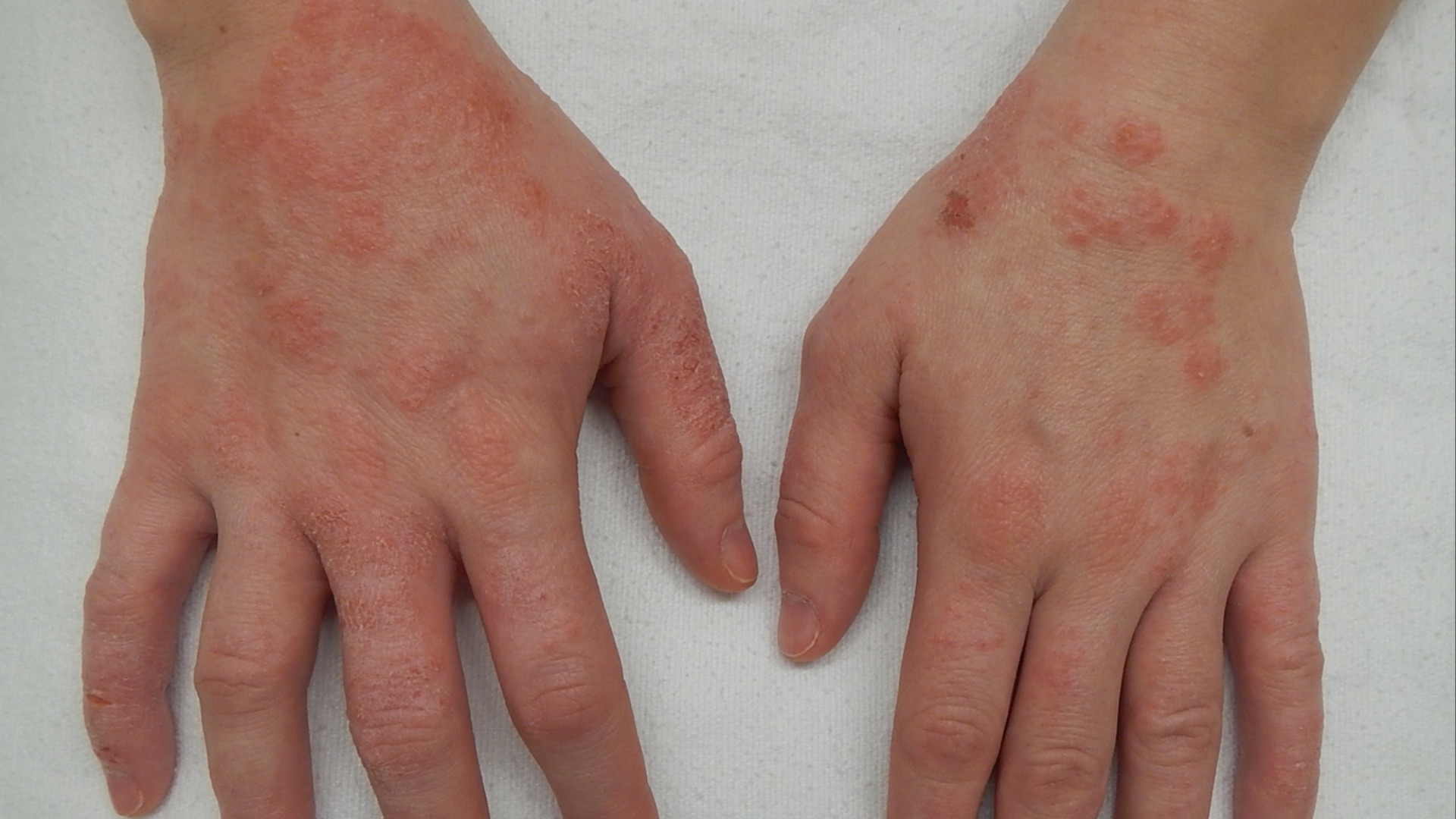 3. L'eczéma et la peau sensible peuvent s'atténuer