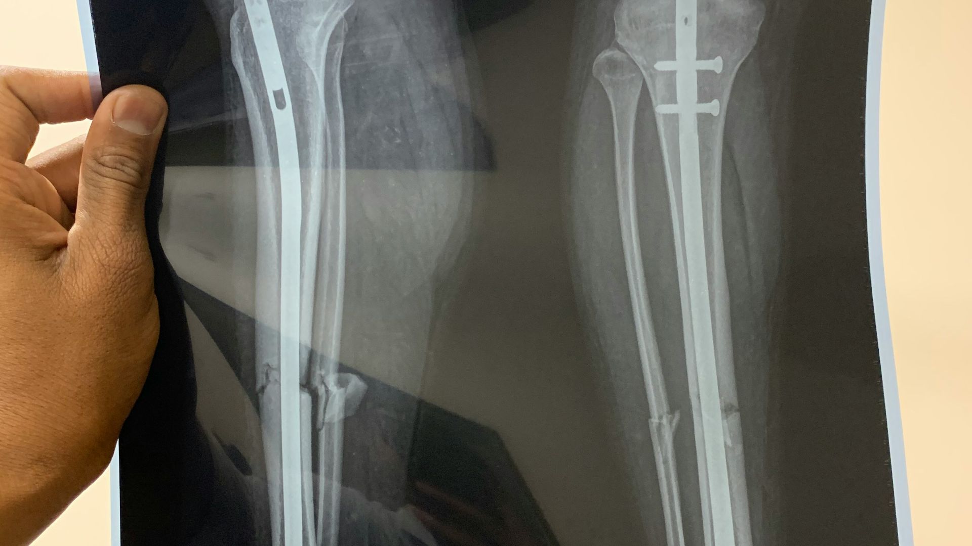 10. Une blessure grave a entraîné un dysfonctionnement permanent