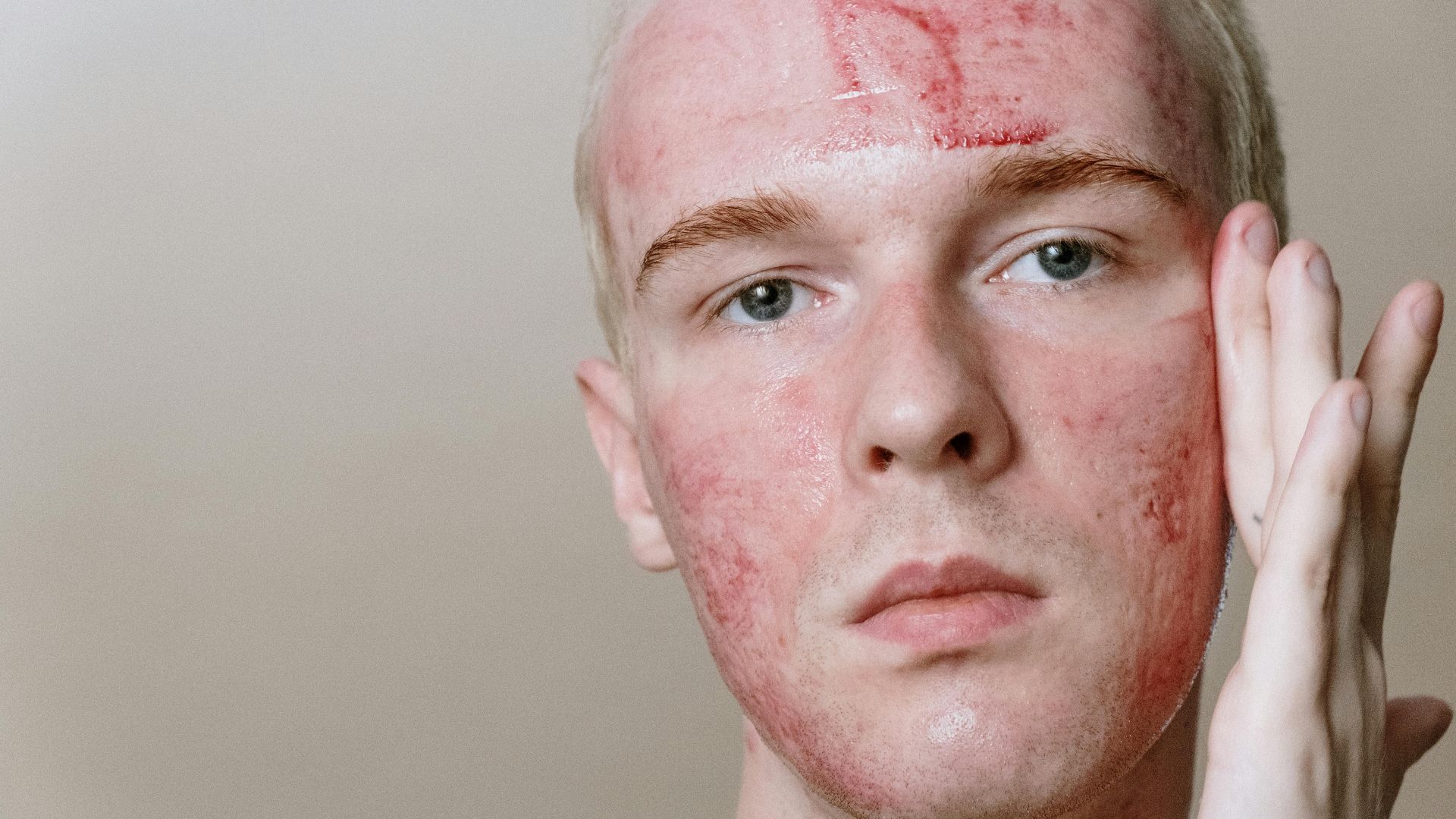 9. Teint et rougeurs