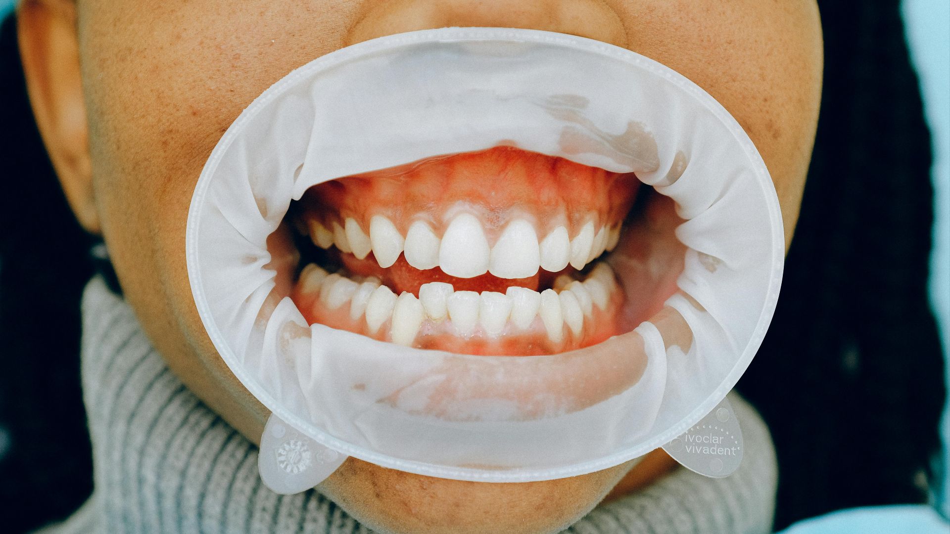 9. Gencives ou langue pâles