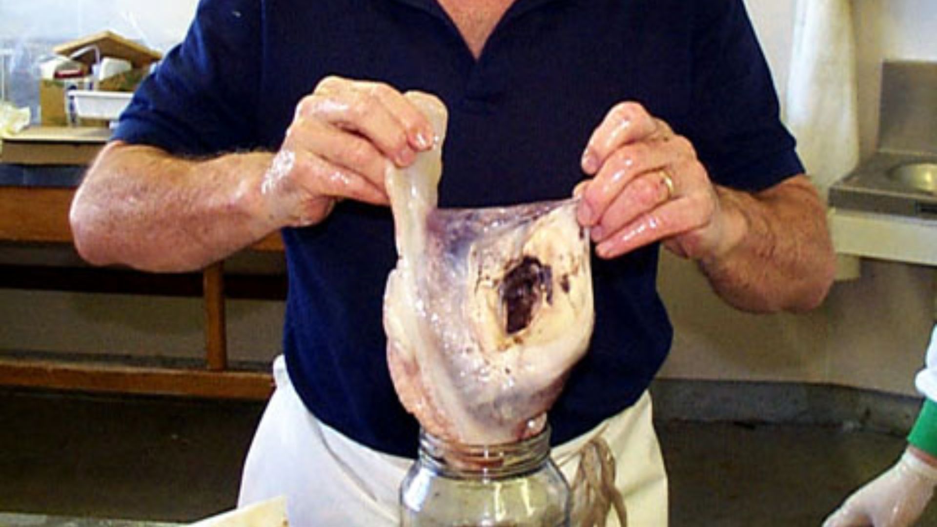 6. Un globe oculaire de la taille d'une balle de softball