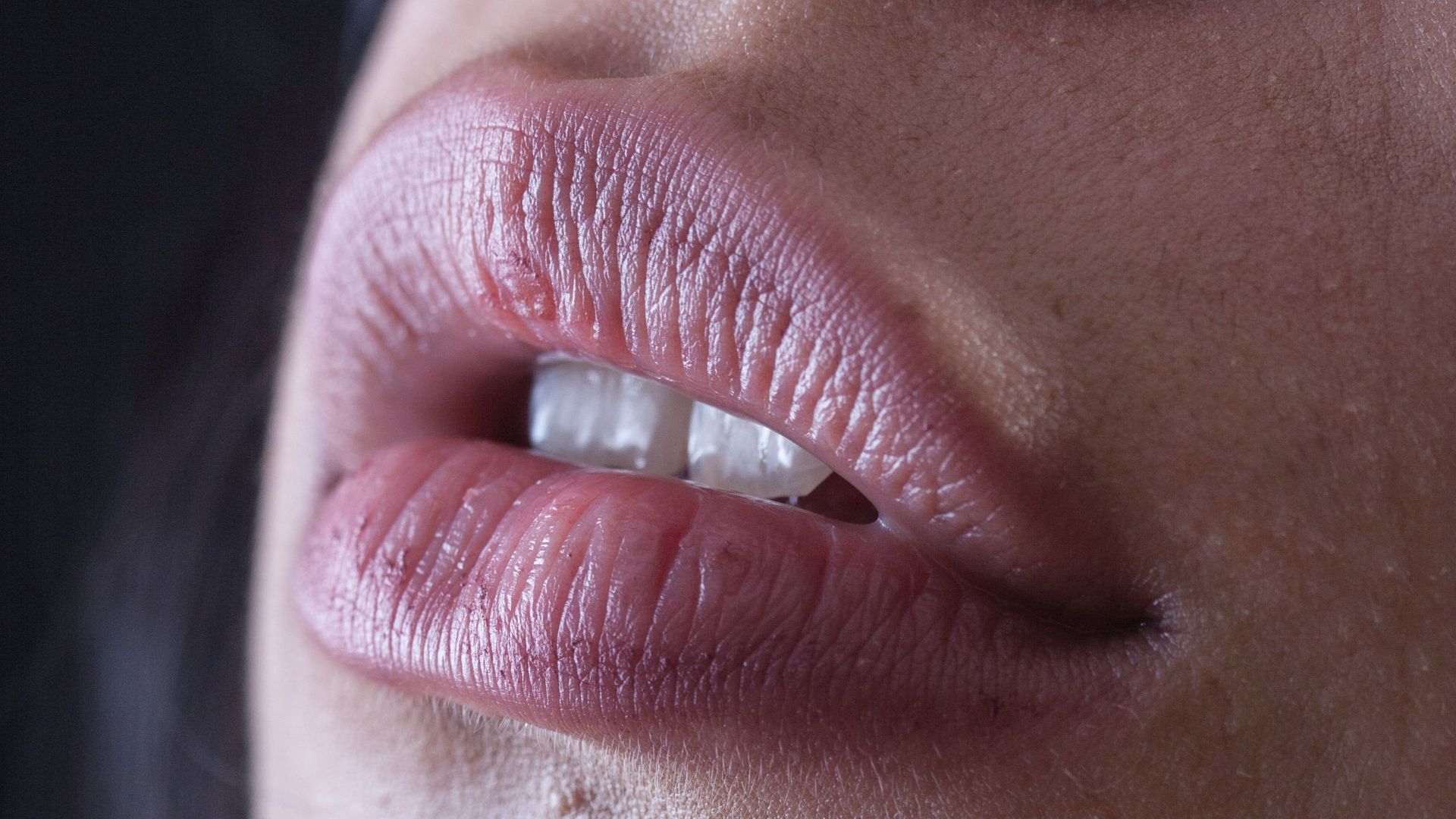 15. Les coins de la bouche gercés