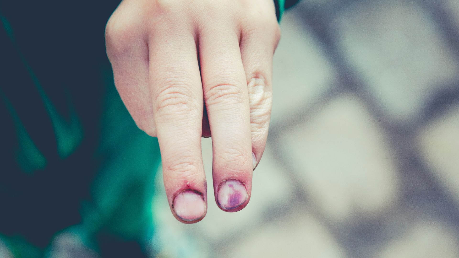 12. Tendance aux ecchymoses