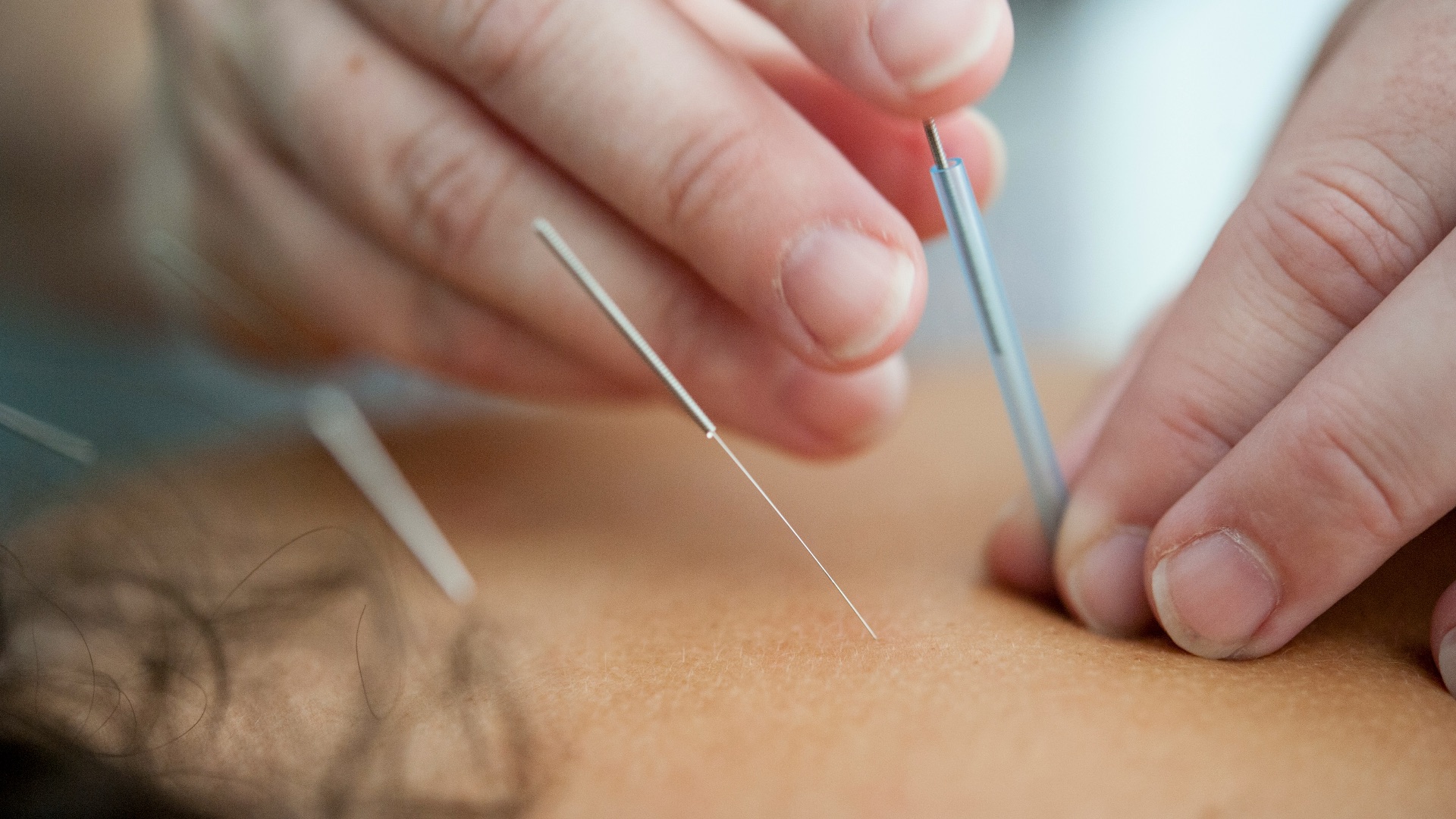 7. Recevoir régulièrement des traitements d'acupuncture