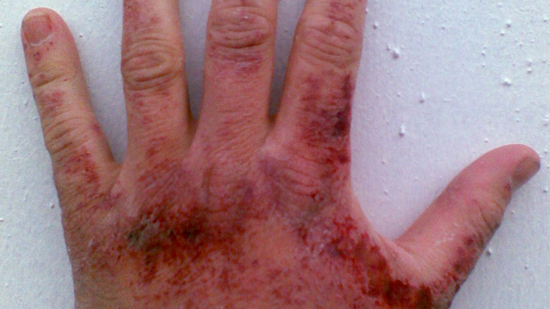 8. La lessive pour les affections cutanées