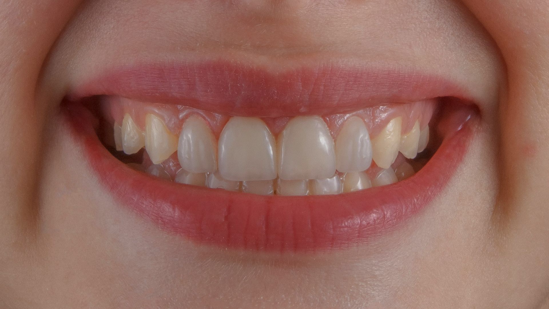 7. Perte des dents