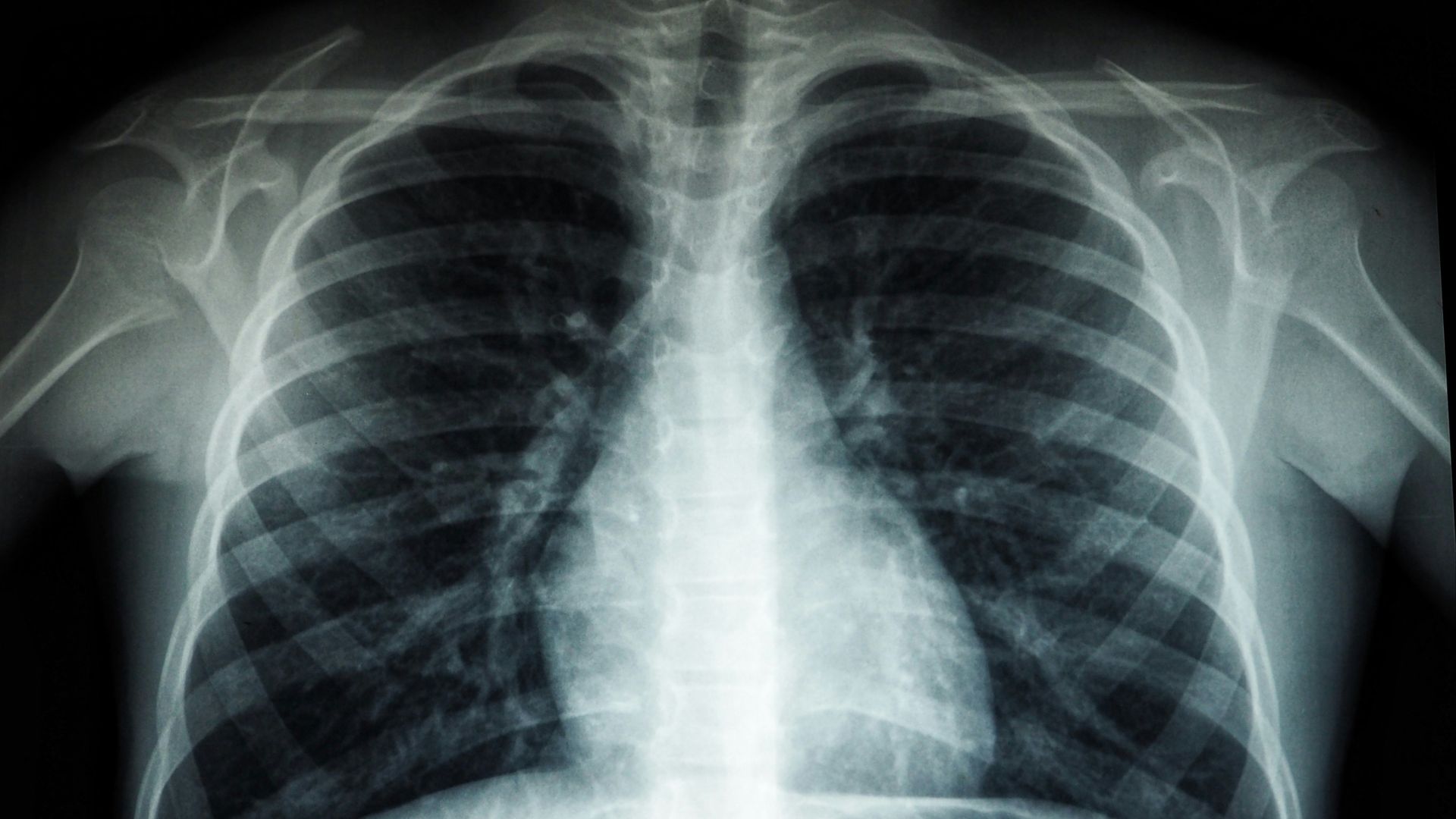 15. Bilan sur le vaccin contre la pneumonie