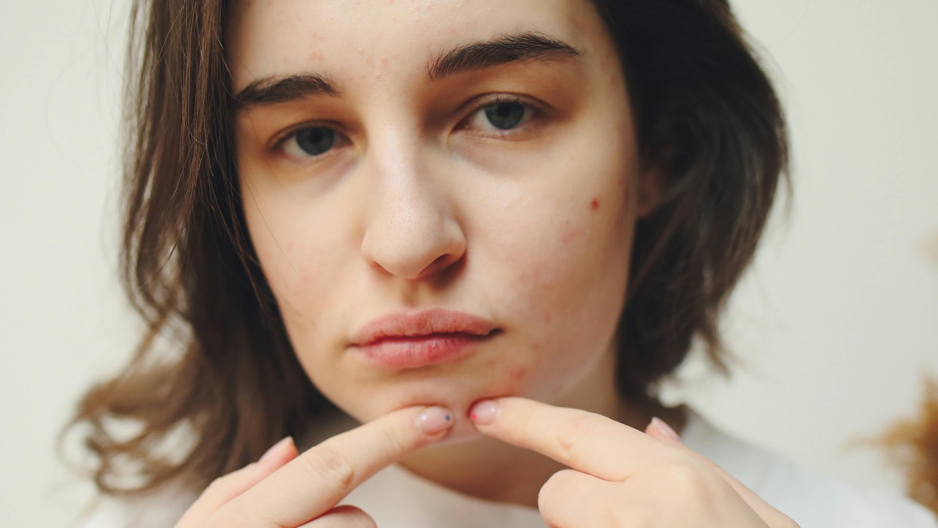 9. Poussées d'acné liées au cycle menstruel