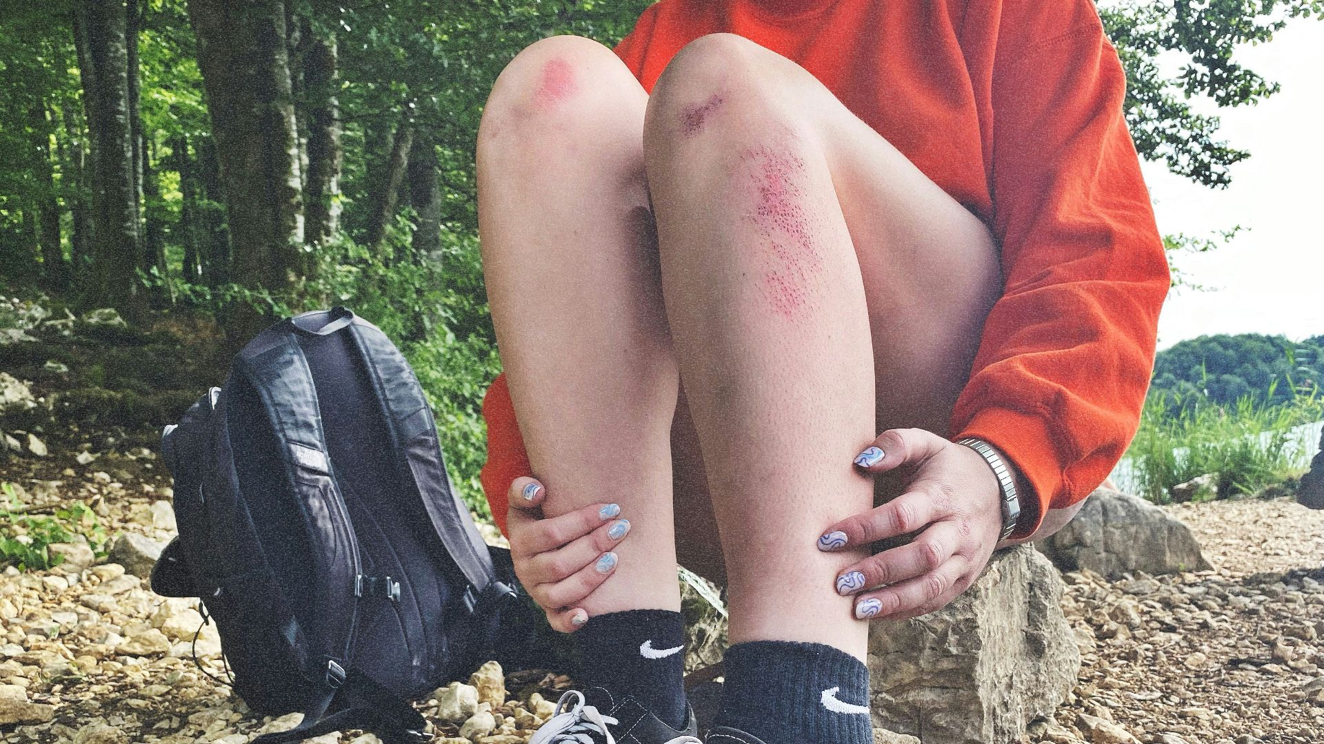 7. Les petites blessures semblent mettre du temps à cicatriser