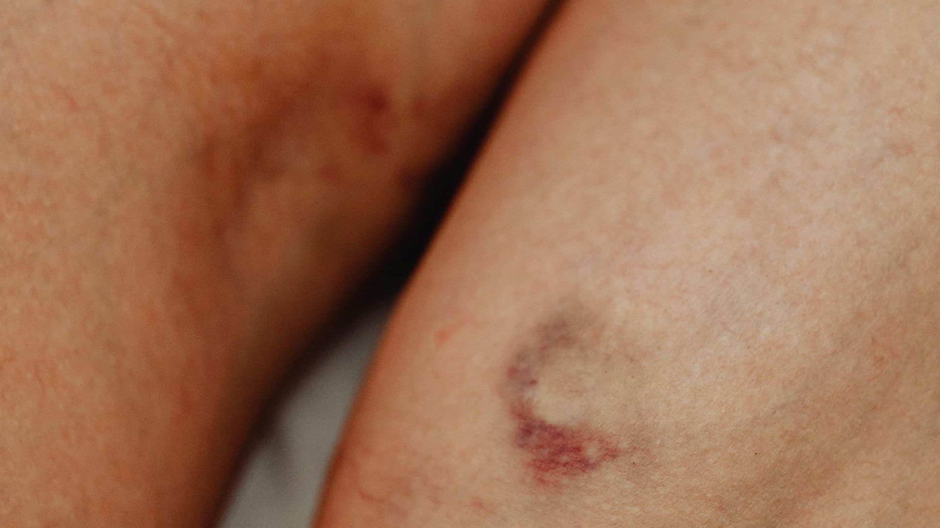 6. Vous avez des plaies qui cicatrisent lentement aux pieds ou aux jambes