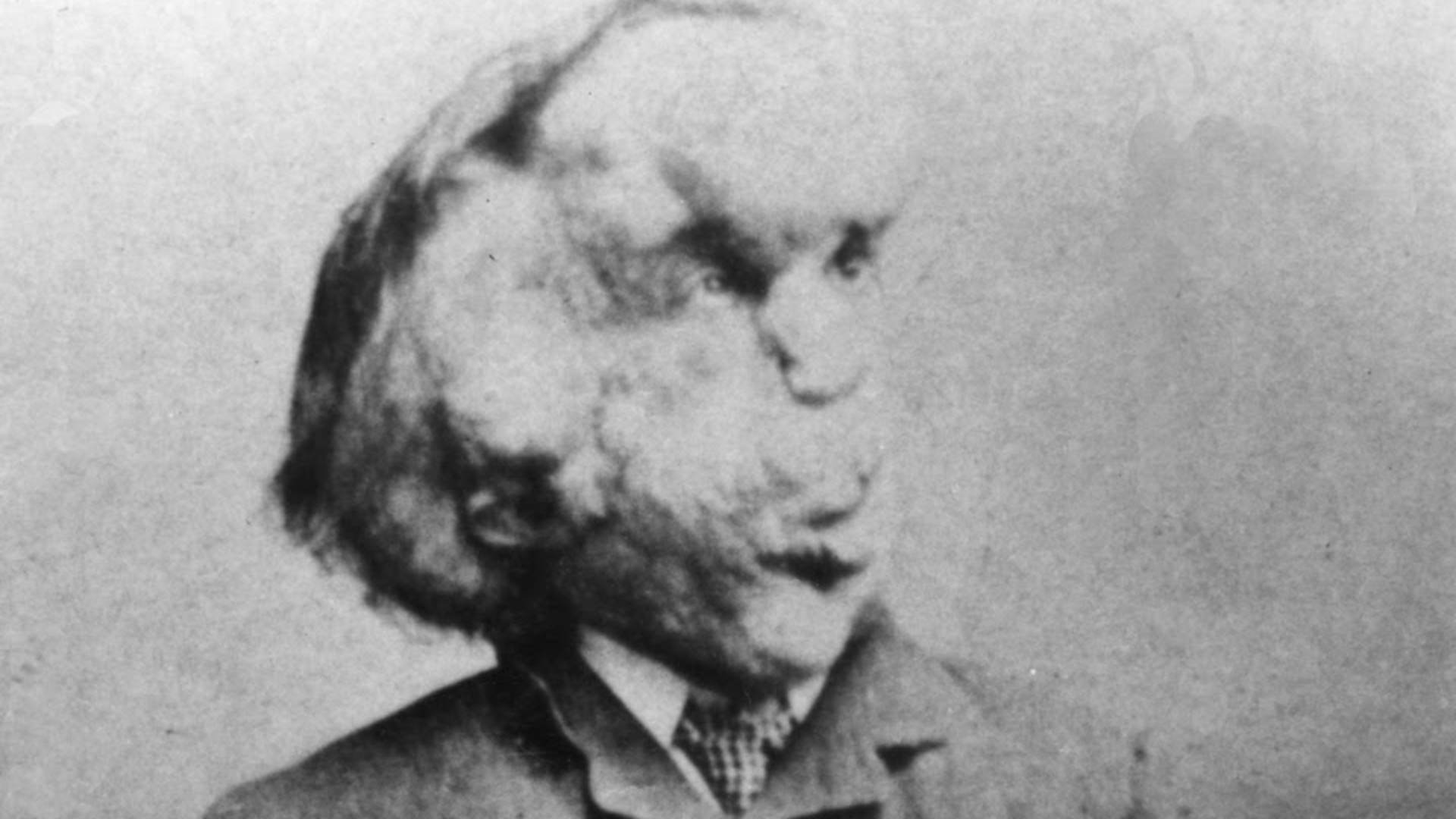 17. Joseph Merrick