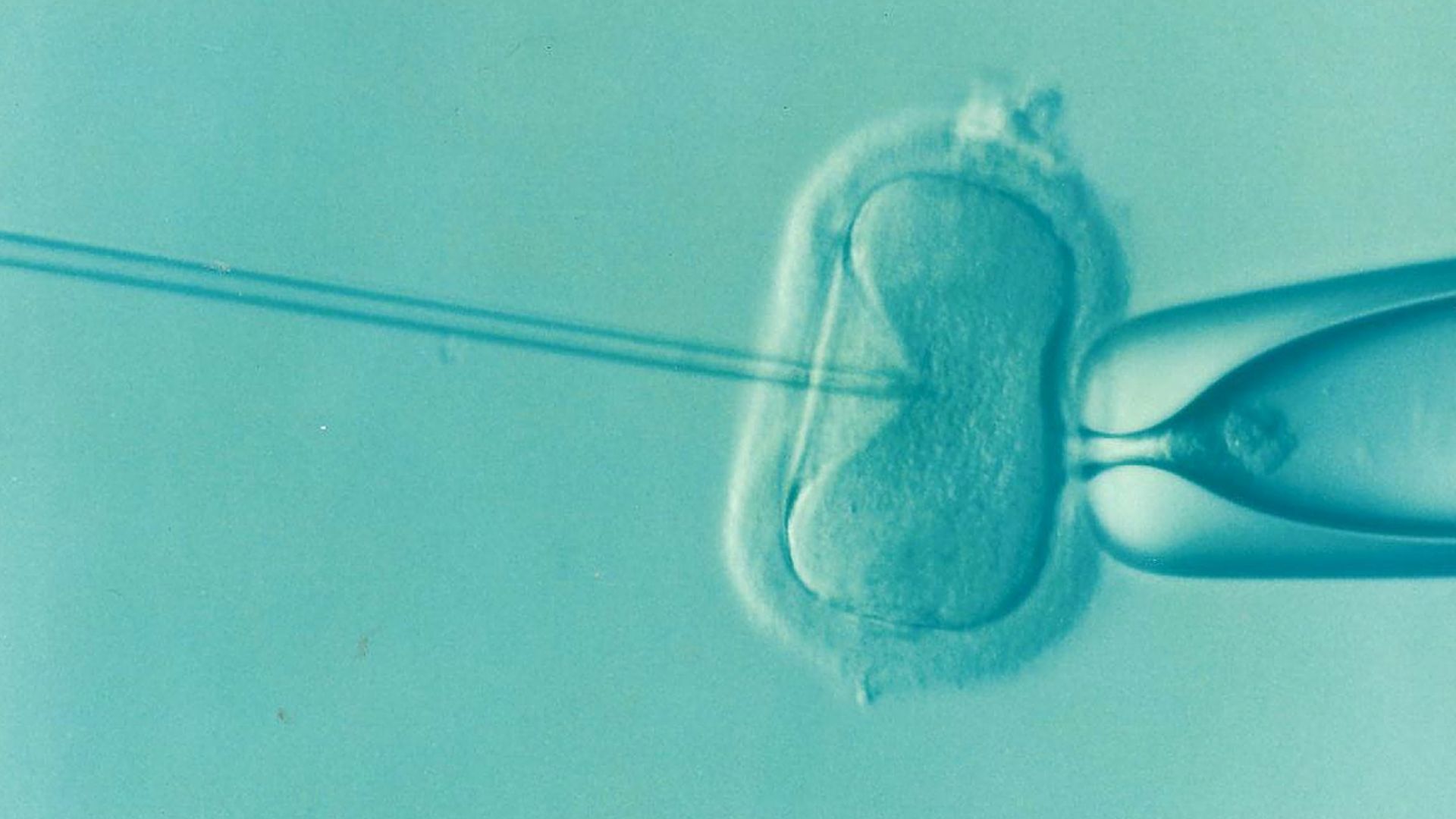 20. La première naissance issue d'une FIV