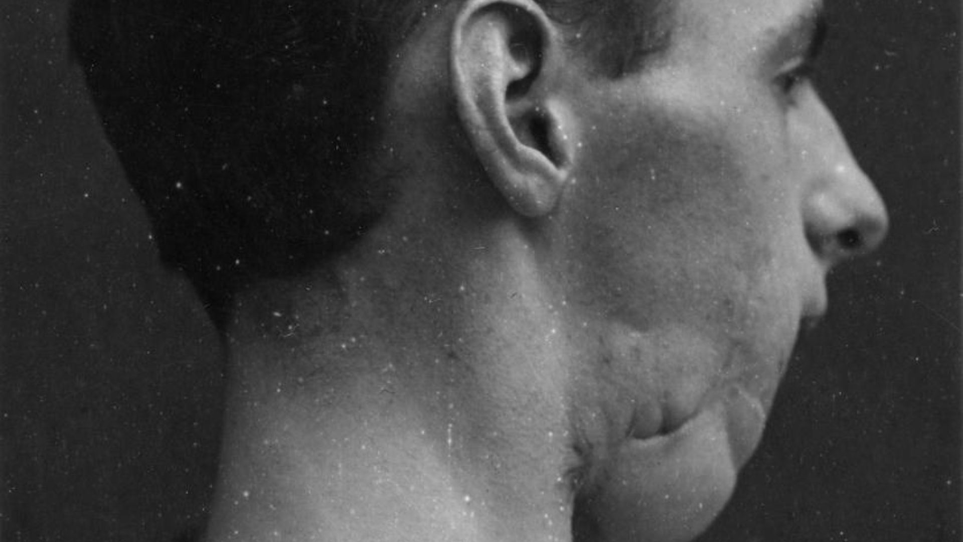 5. La chirurgie plastique moderne pendant la Première Guerre mondiale