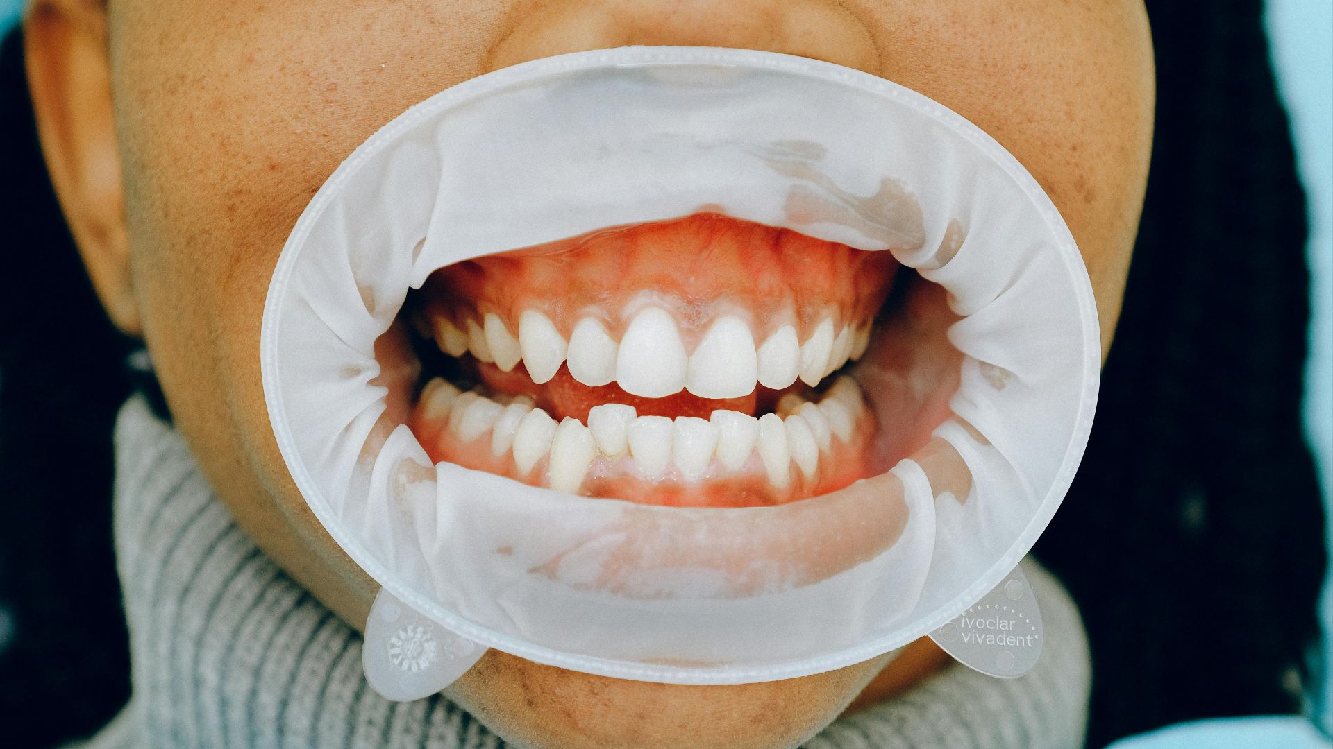 8. Vos gencives saignent facilement